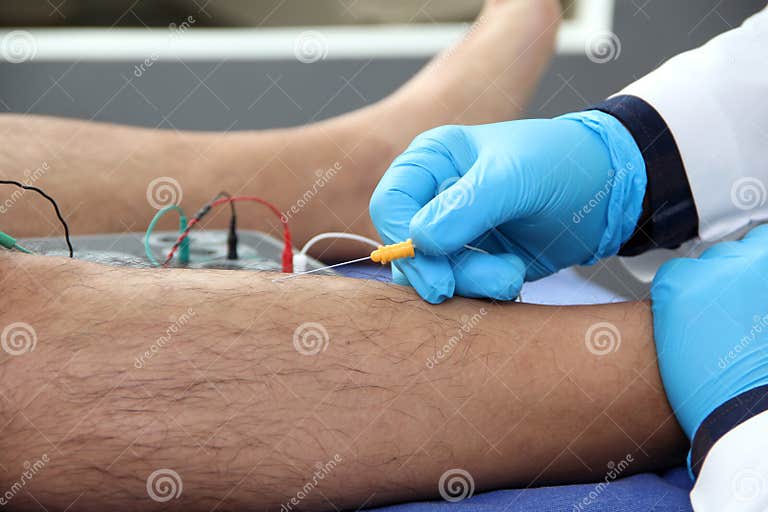 Electromyography Graphic Recording of the Electrical Activity Produced