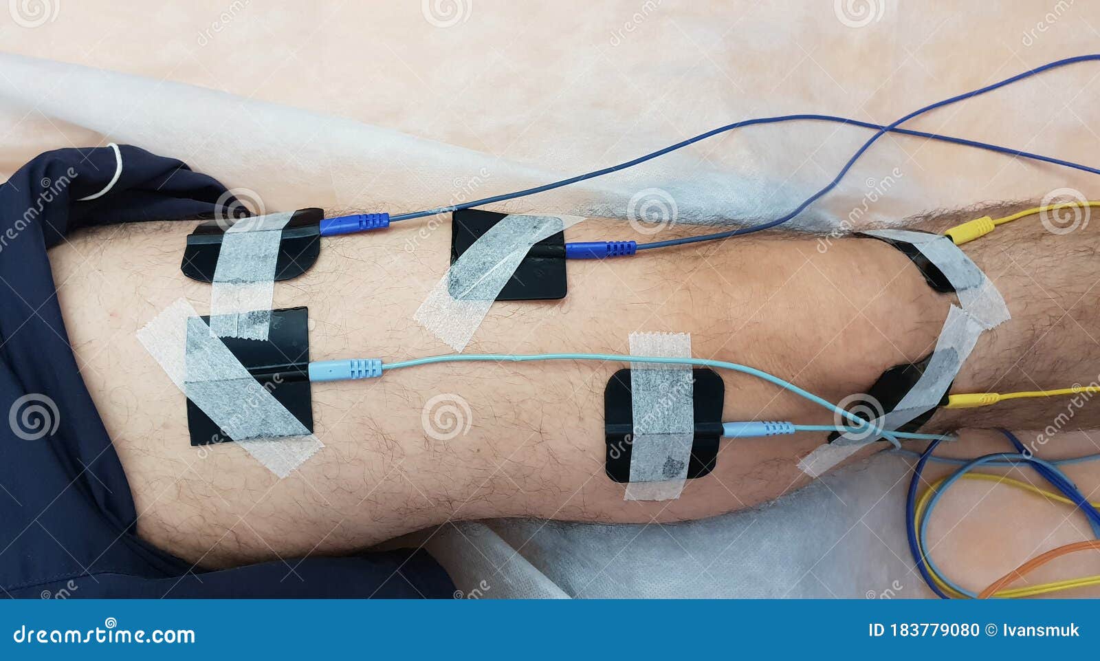 Electrostimulation of the Quadriceps As a Physiotherapy Stock Photo