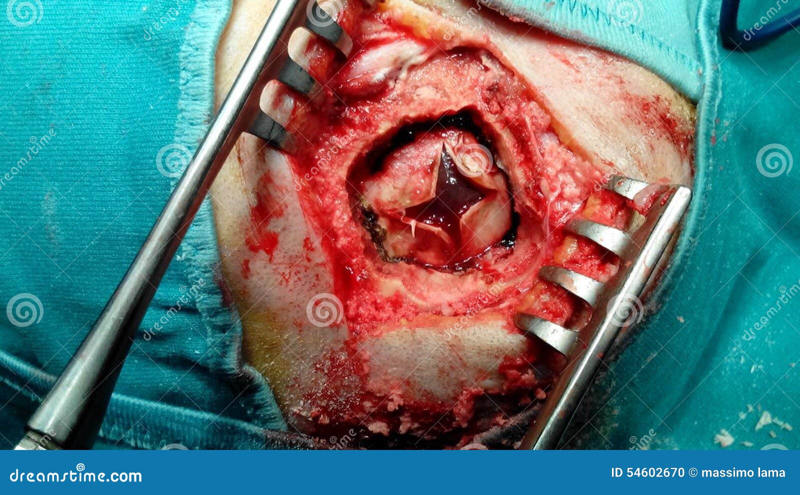 Ematoma Subdurale Cronico Fotografia Stock Immagine Di Neurochirurgia 54602670