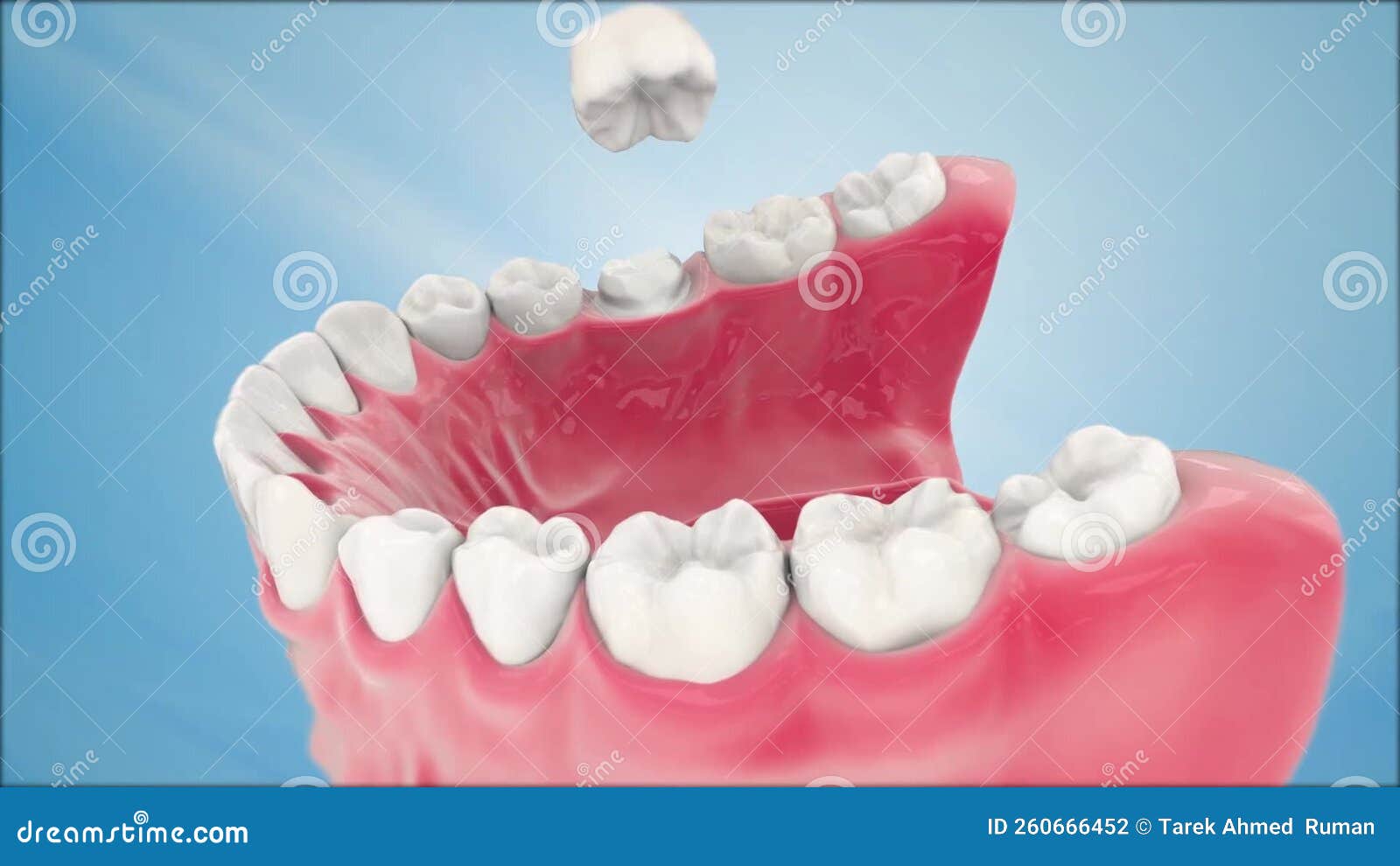 Endodontic Root Canal Treatment Process. Medically Accurate Tooth 3D
