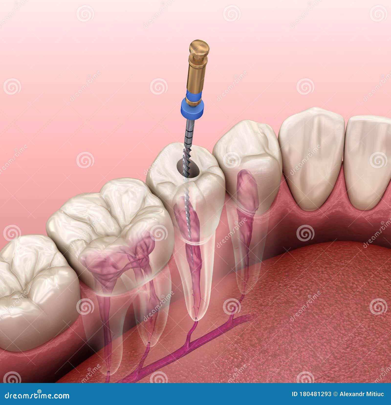 endodontic root canal treatment process. medically accurate tooth 