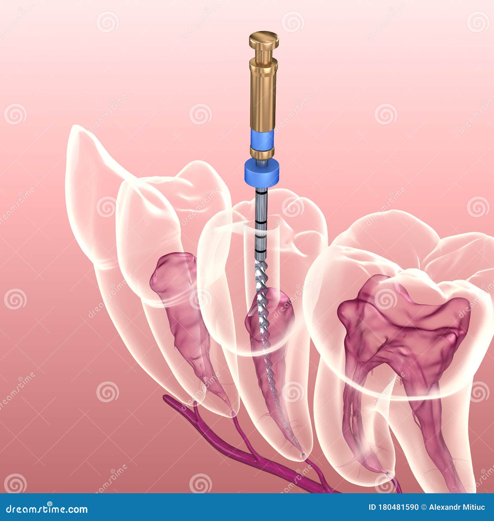 endodontic root canal treatment process. medically accurate tooth 