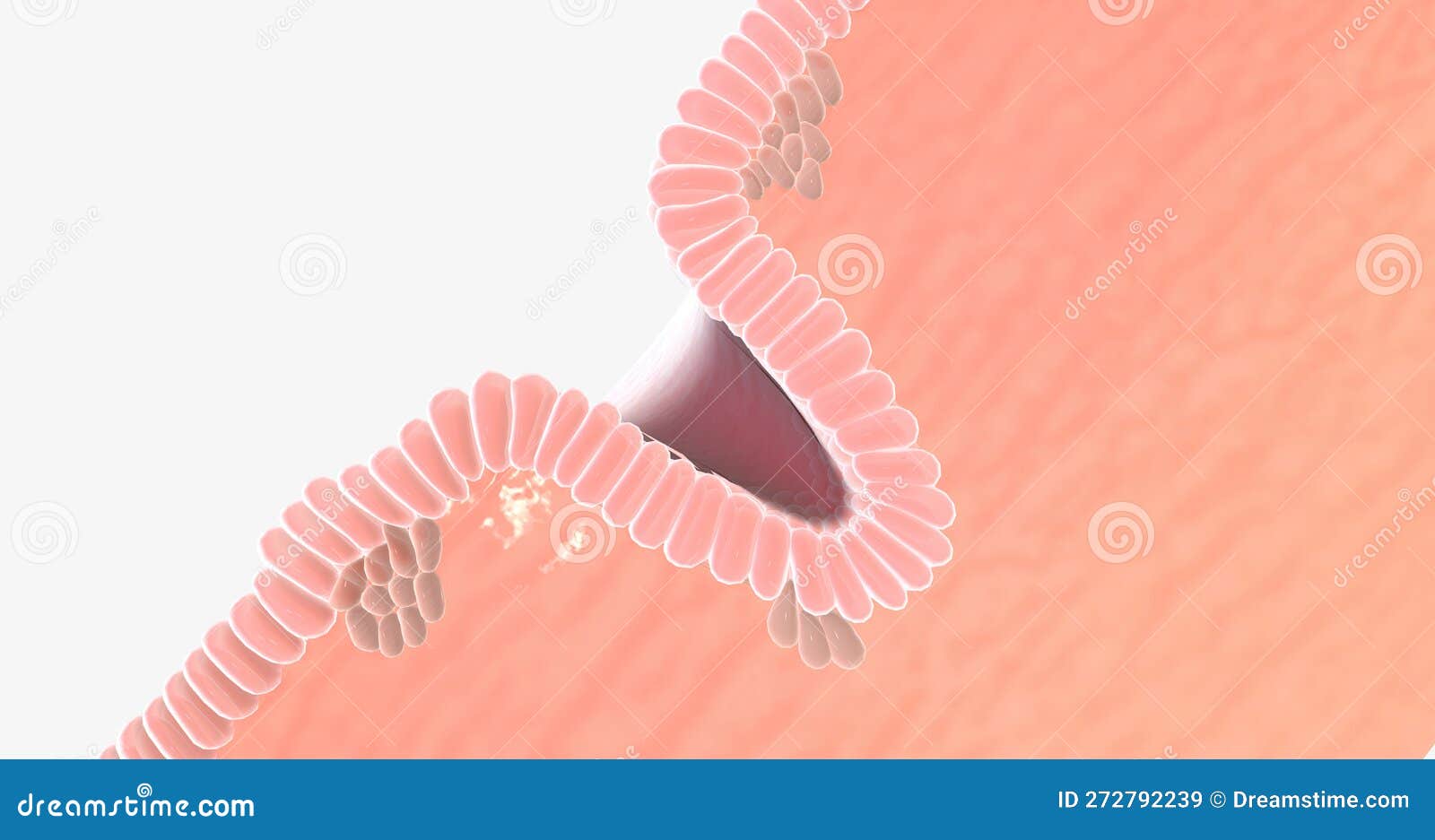 endometrial cancer type 2