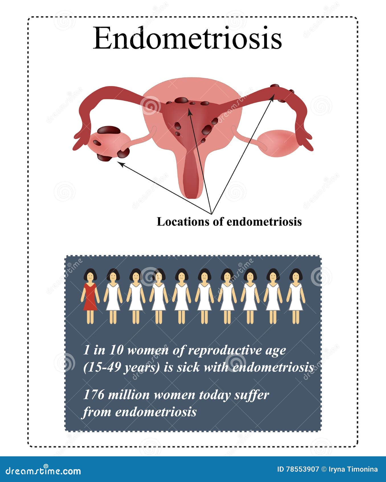 Relativamente Al Legame Tra Endometriosi E Depressione Endometriosi Illustrazione Di Vettore Su Fondo Illustrazione Vettoriale