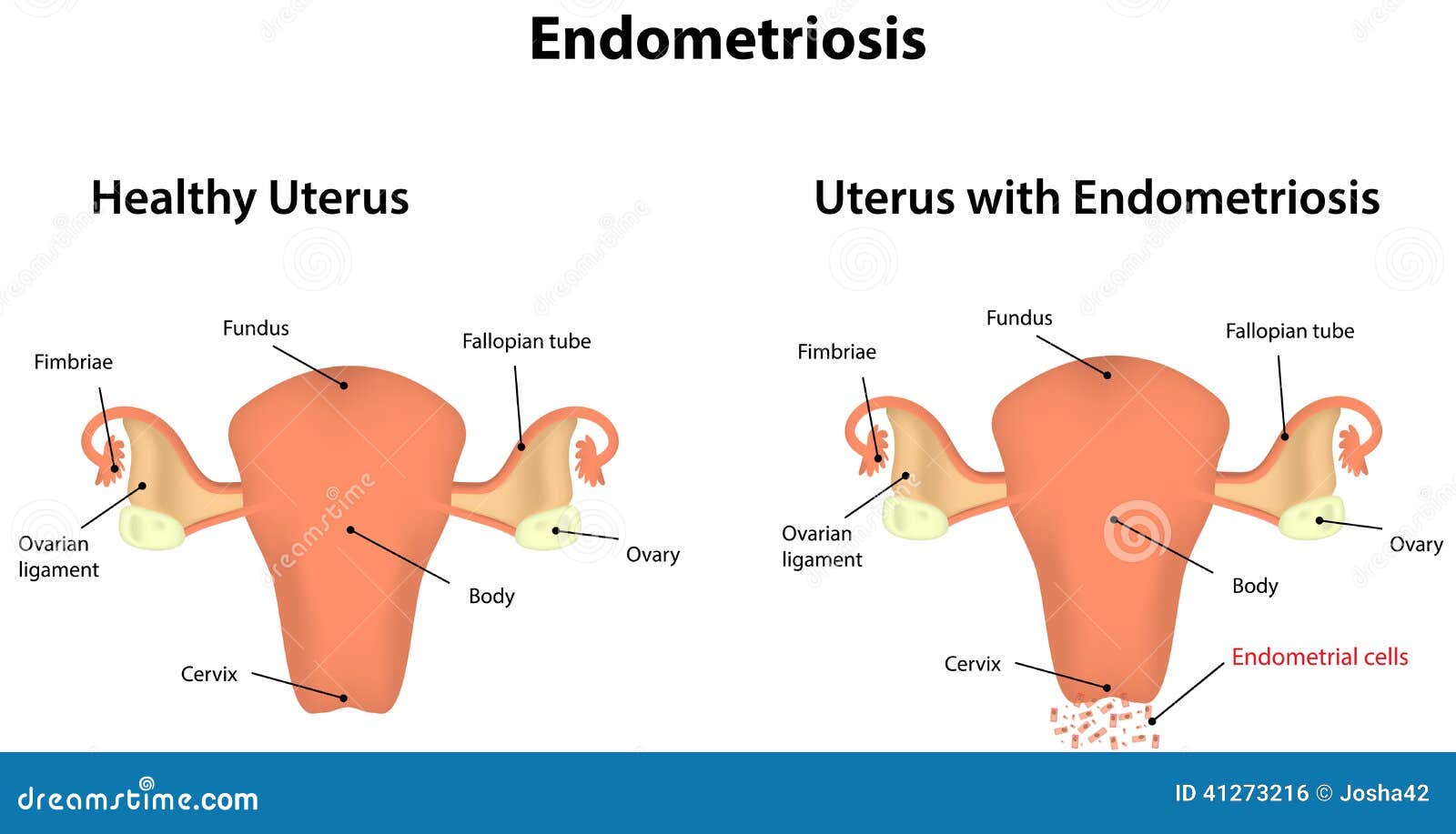 Endometriosis stock vector. Illustration of ovarian, inflammation 41273216