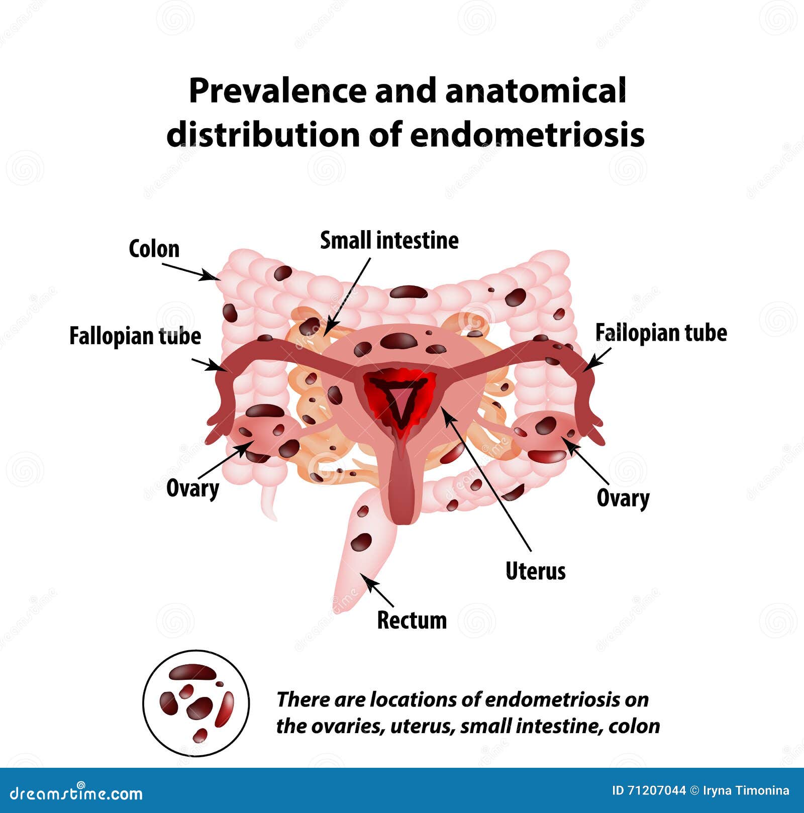 Relativamente Al Legame Tra Endometriosi E Depressione Endometriosis De Verschijning Van Ziekteendometriosis Endometrium