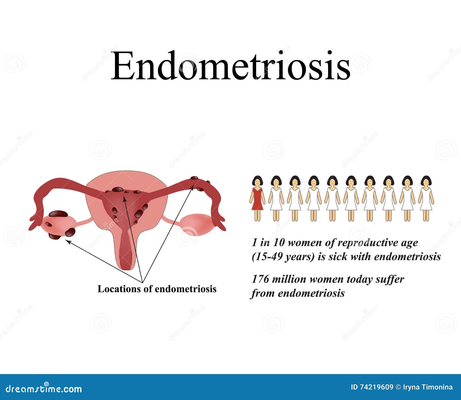 endometrium rák és endometriosis