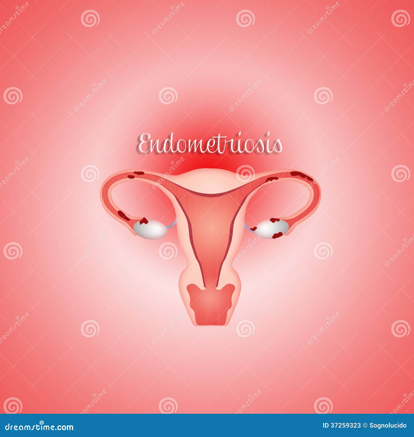 Endometriosis stock illustration. Image of ovulation 37259323