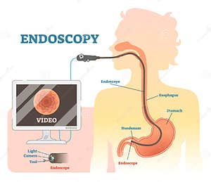 Endoscopy Cartoons Illustrations Vector Stock Images 1409 Pictures 