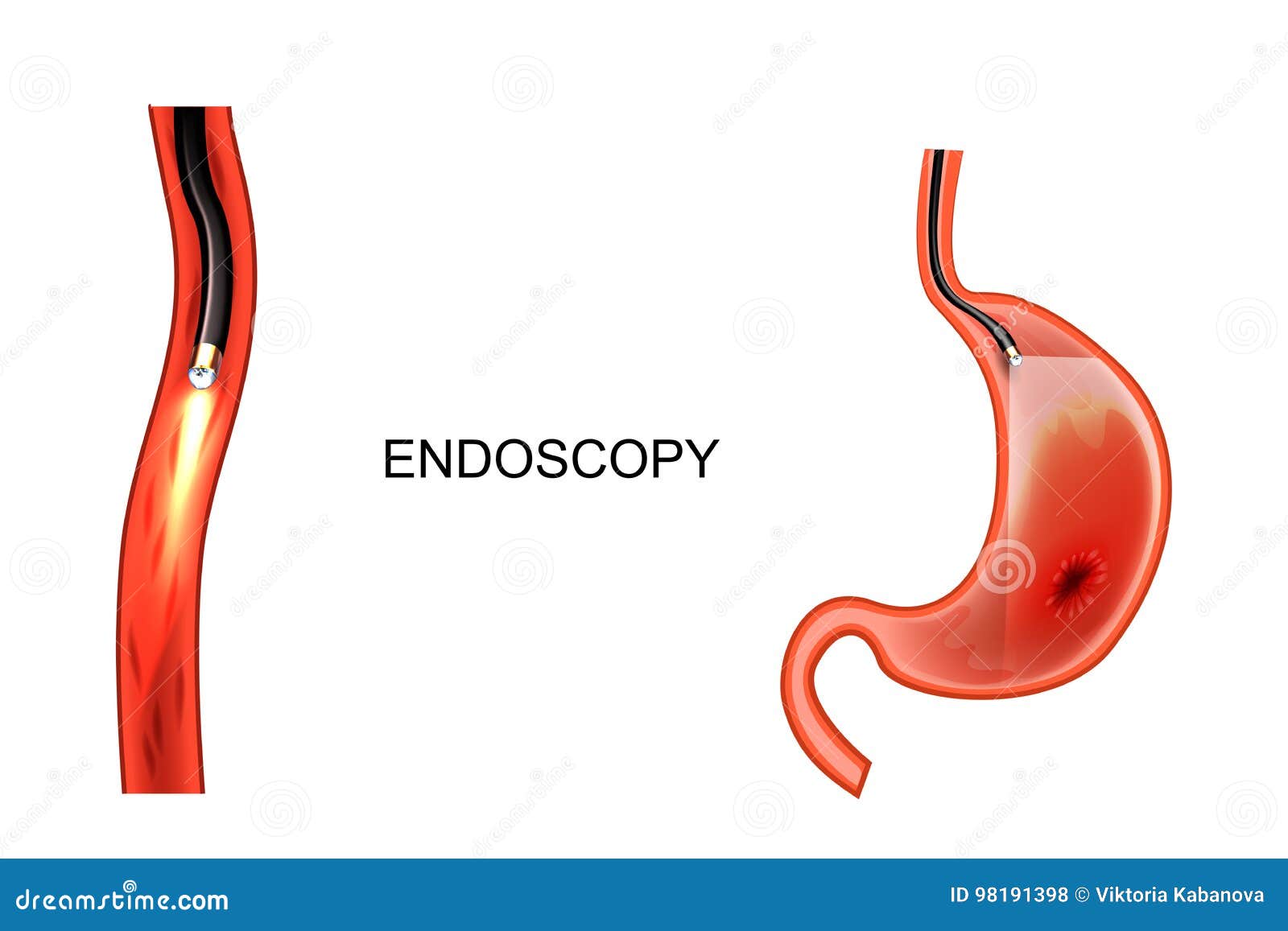 endoscopy of the stomach. egd. ulcer, cancer
