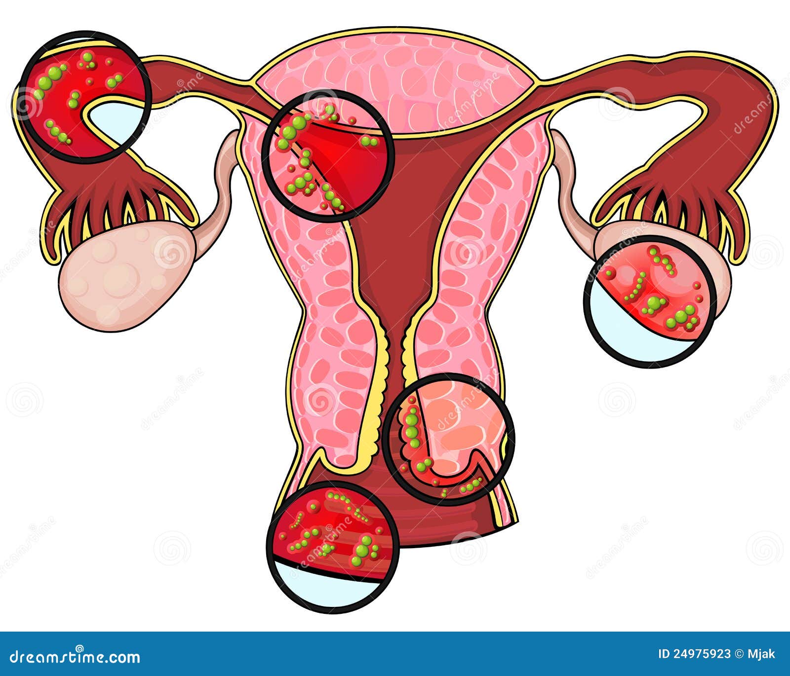 Duplicar Dureza Umeki Enfermedades Del Sistema Reproductivo Femenino Ilustración del Vector - Ilustración de esquema, virus: 24975923 Duplicar Dureza Umeki Enfermedades Del Sistema Reproductivo Femenino Ilustración del Vector - Ilustración de esquema, virus: 24975923