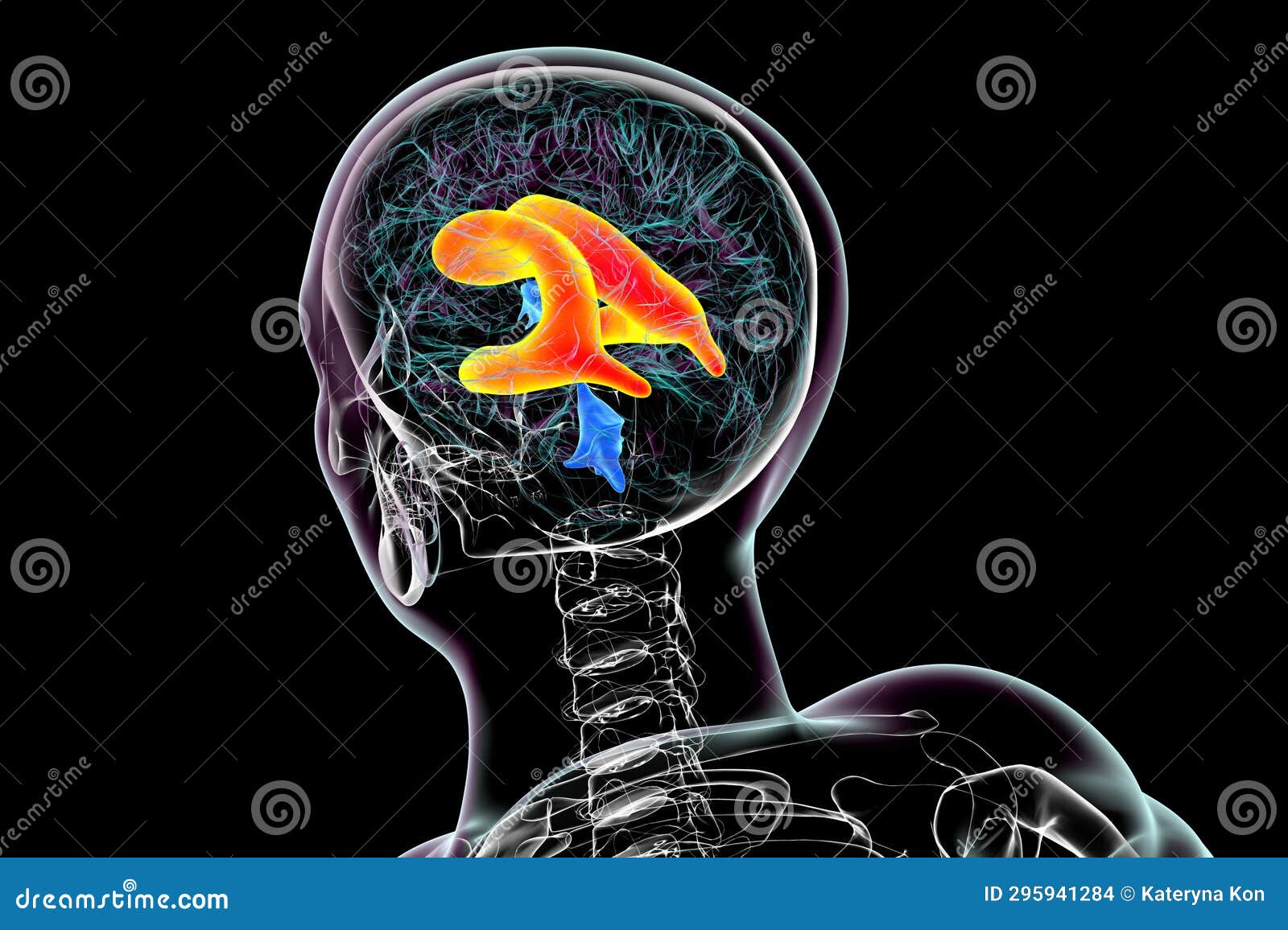 Enlarged Lateral Ventricles Of The Brain 3d Illustration Stock