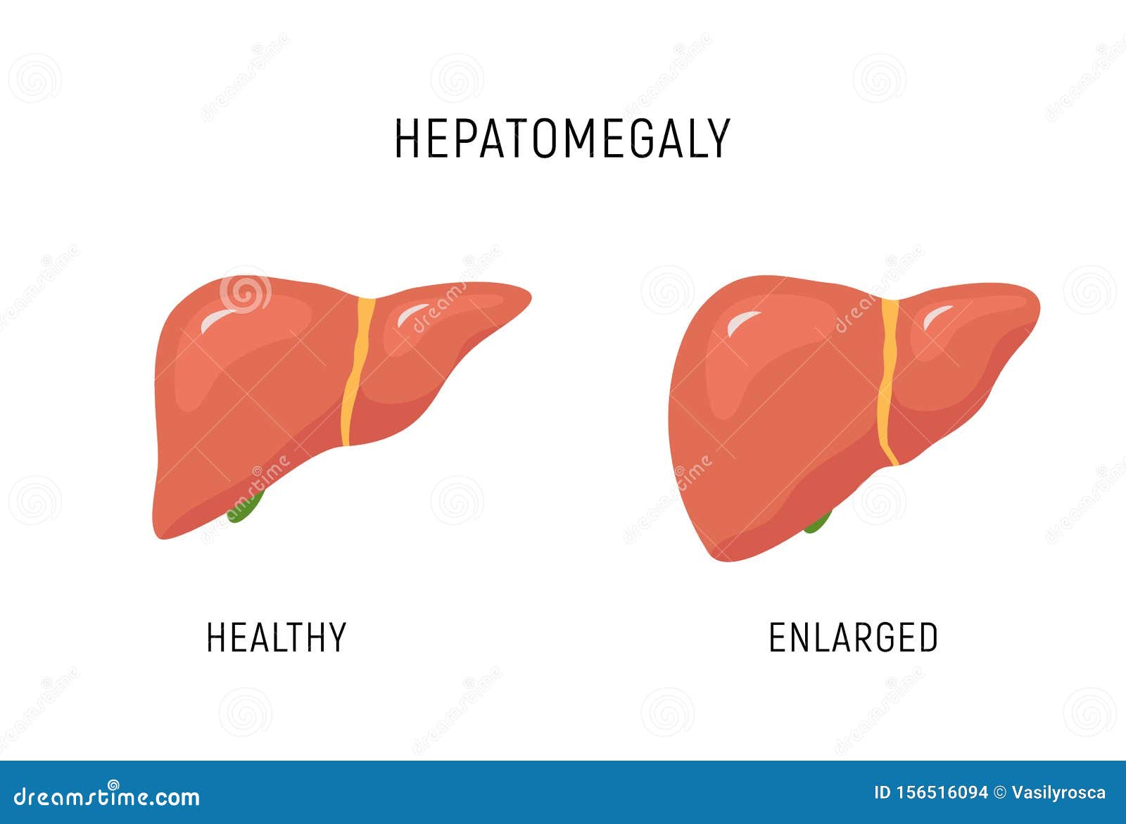 Hepatomegaly Stock Illustrations 33 Hepatomegaly Stock Illustrations Vectors Clipart Dreamstime