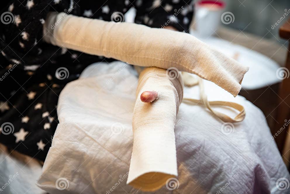 Epidermolysis Bullosa, Patient with Hand Bandages Stock Image - Image ...
