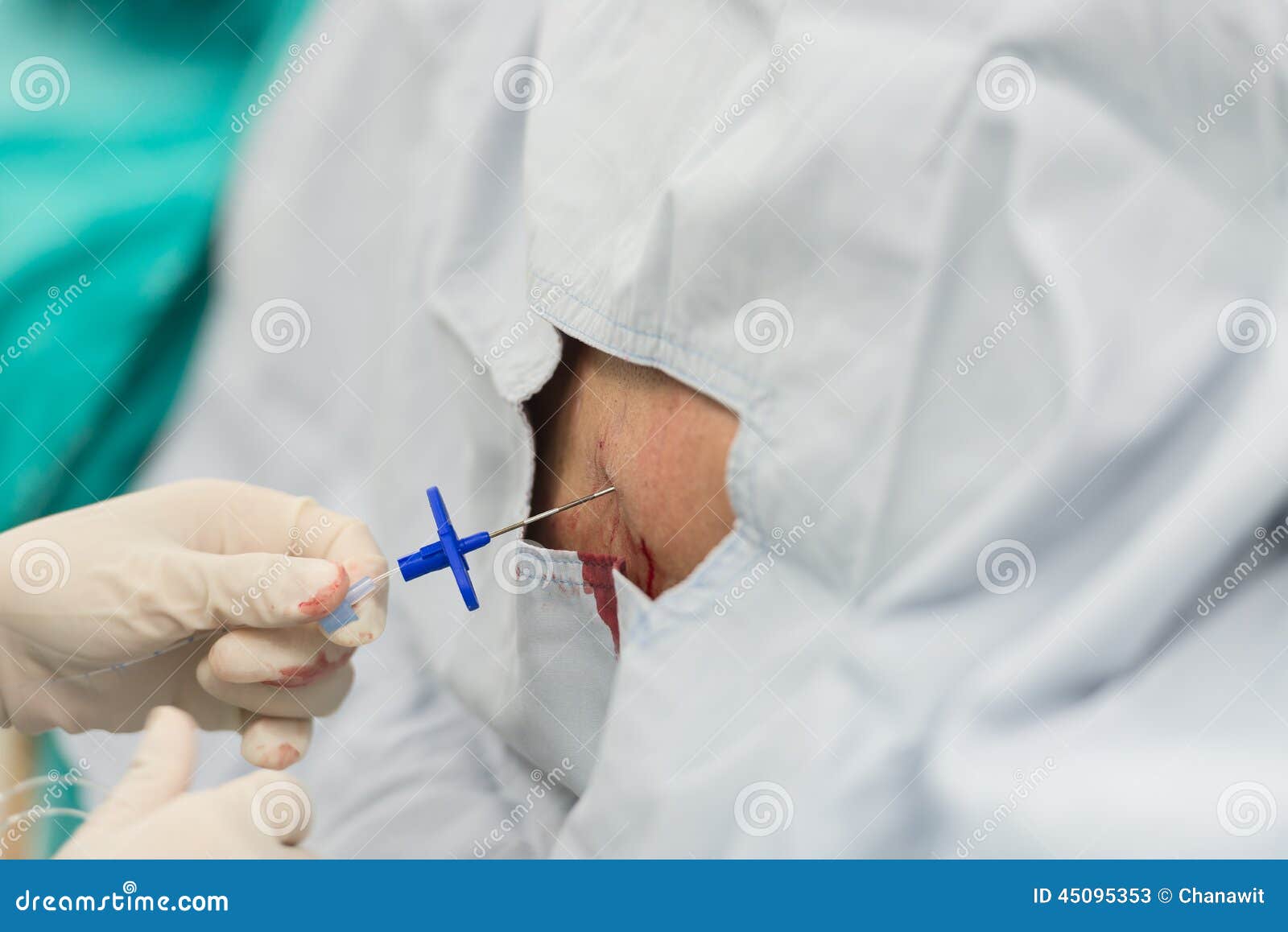 Epidural analgesia stock image. Image of catheter, procedure 45095353