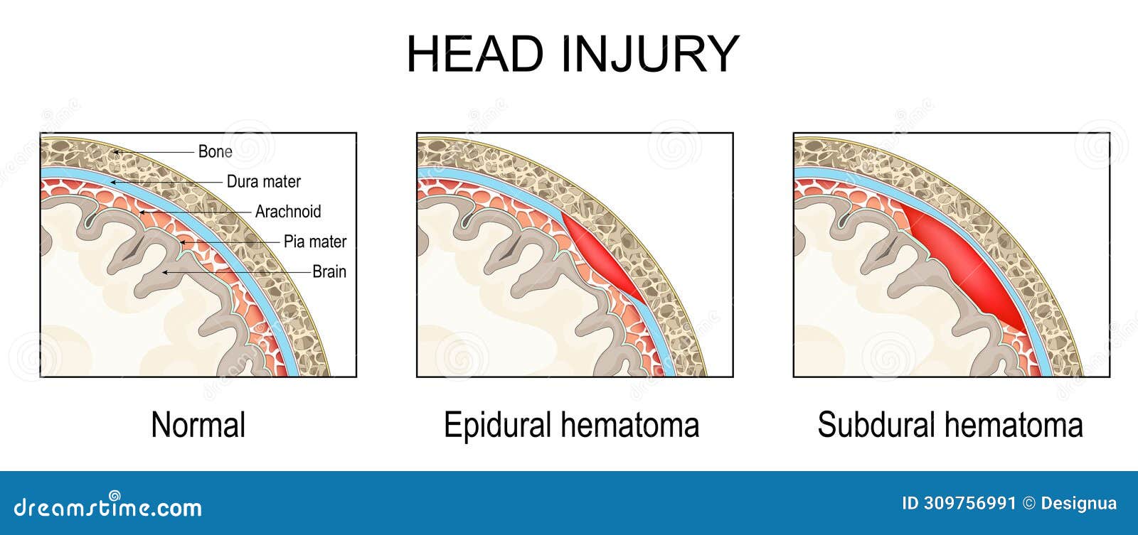 epidural hematoma and subdural hematoma. traumatic brain injury