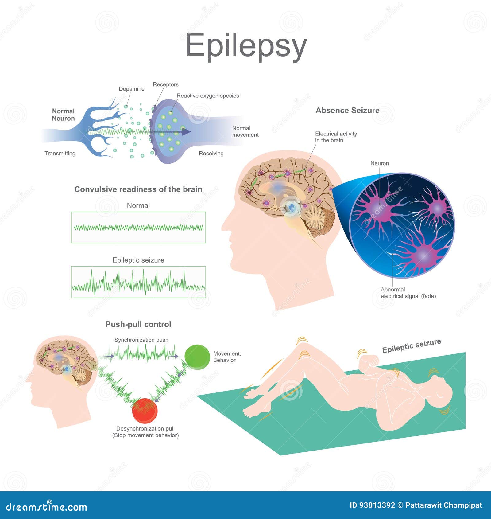 Epilepsi vektor illustrationer. Illustration av syre 93813392