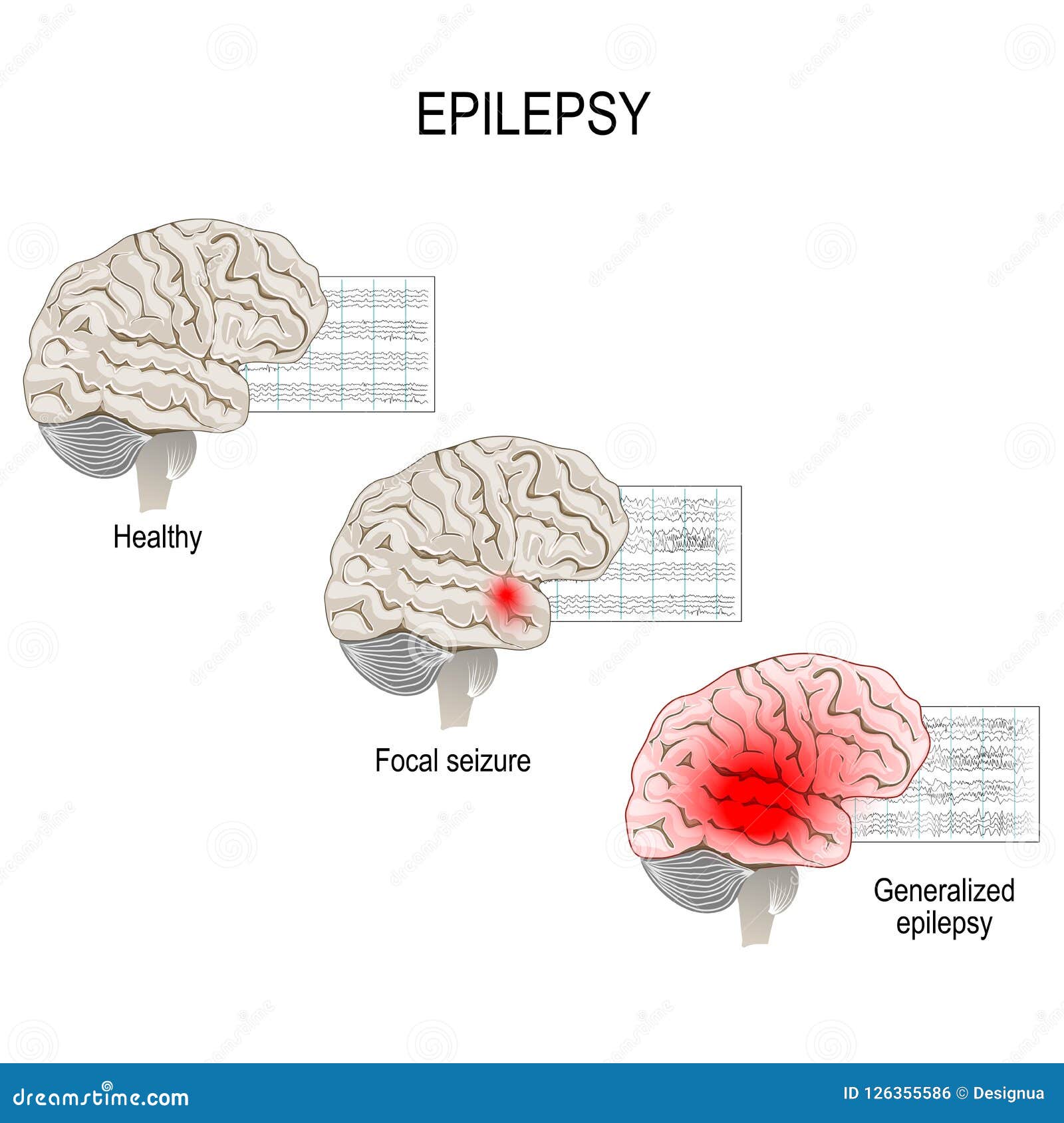 Epilepsy Brain Diagram