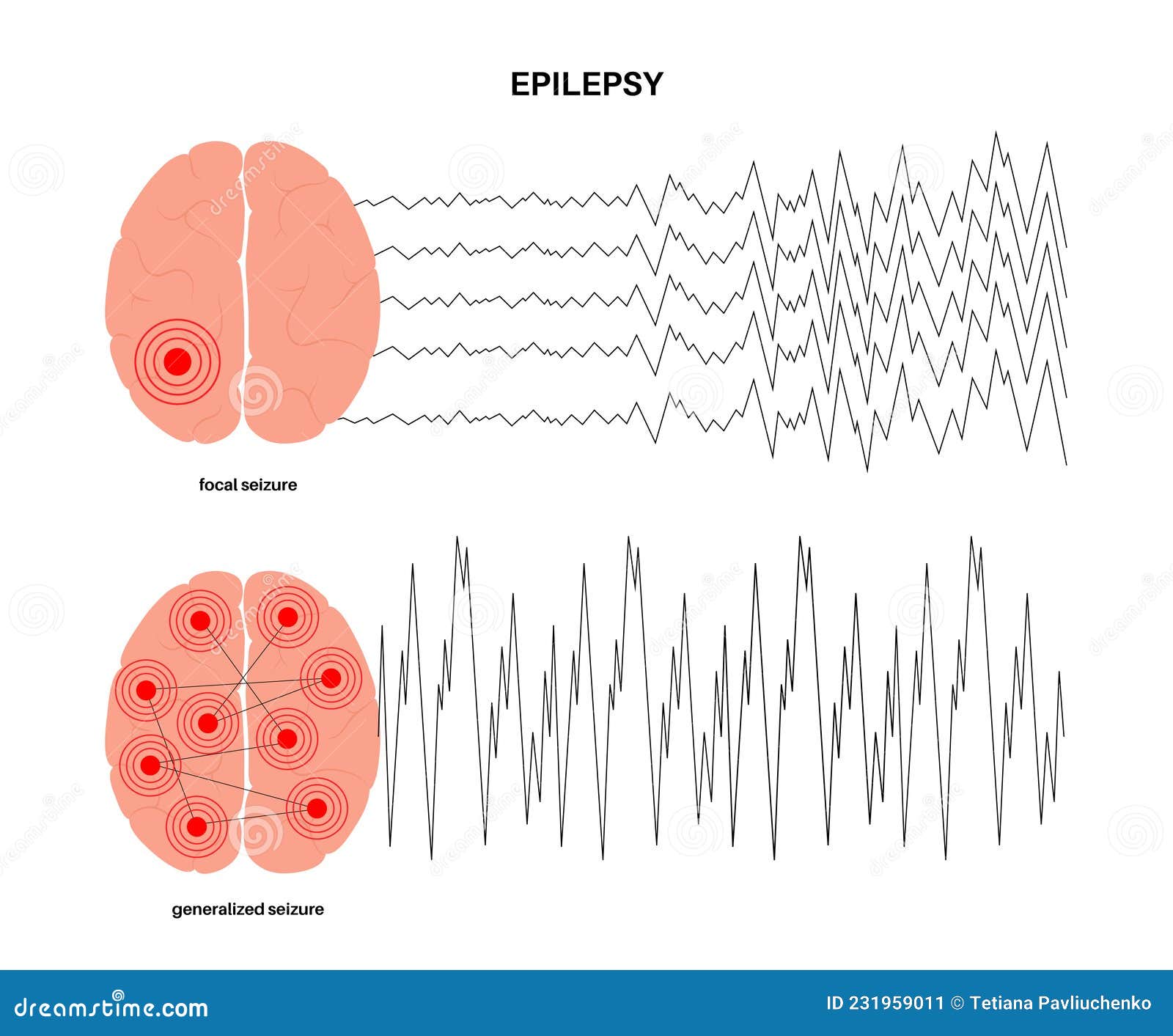 Epilepsy seizure concept stock vector. Illustration of partial - 231959011