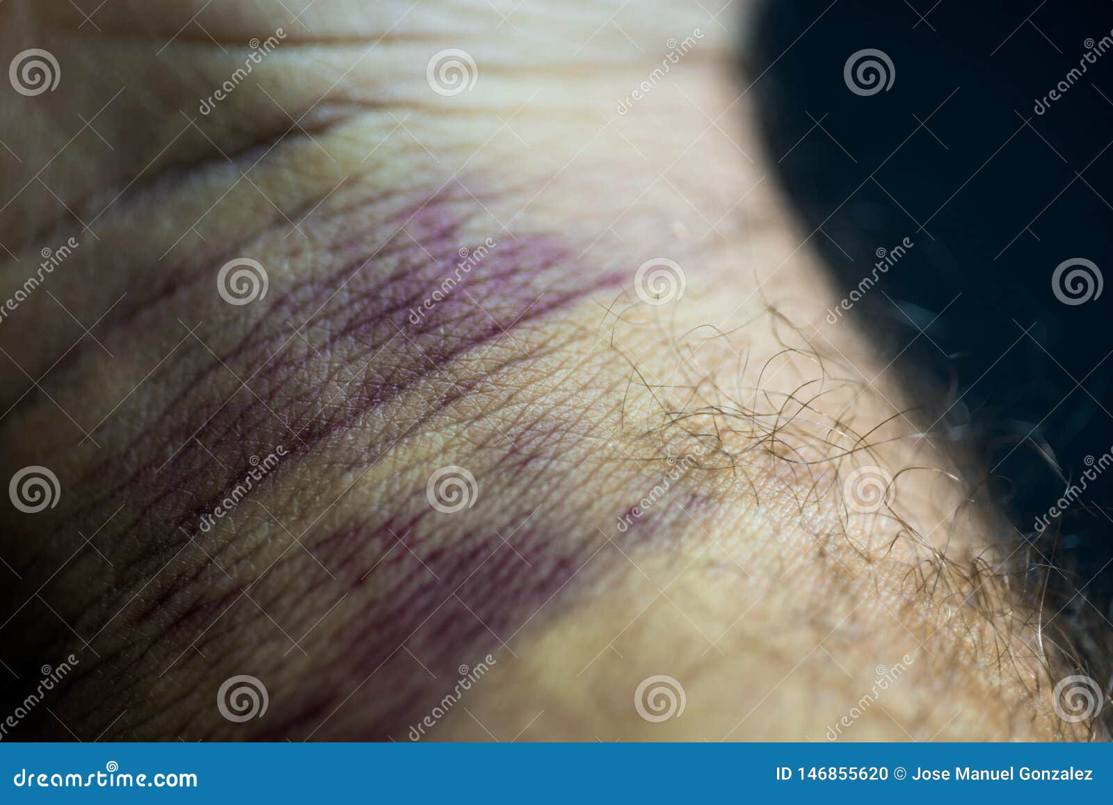 Bruise on Man Arm. Injection Bruises. High Contrast Macro Photography.  Purple Veins on the Wrist Foto de Stock - Imagem de focalizado, tecido:  146855620