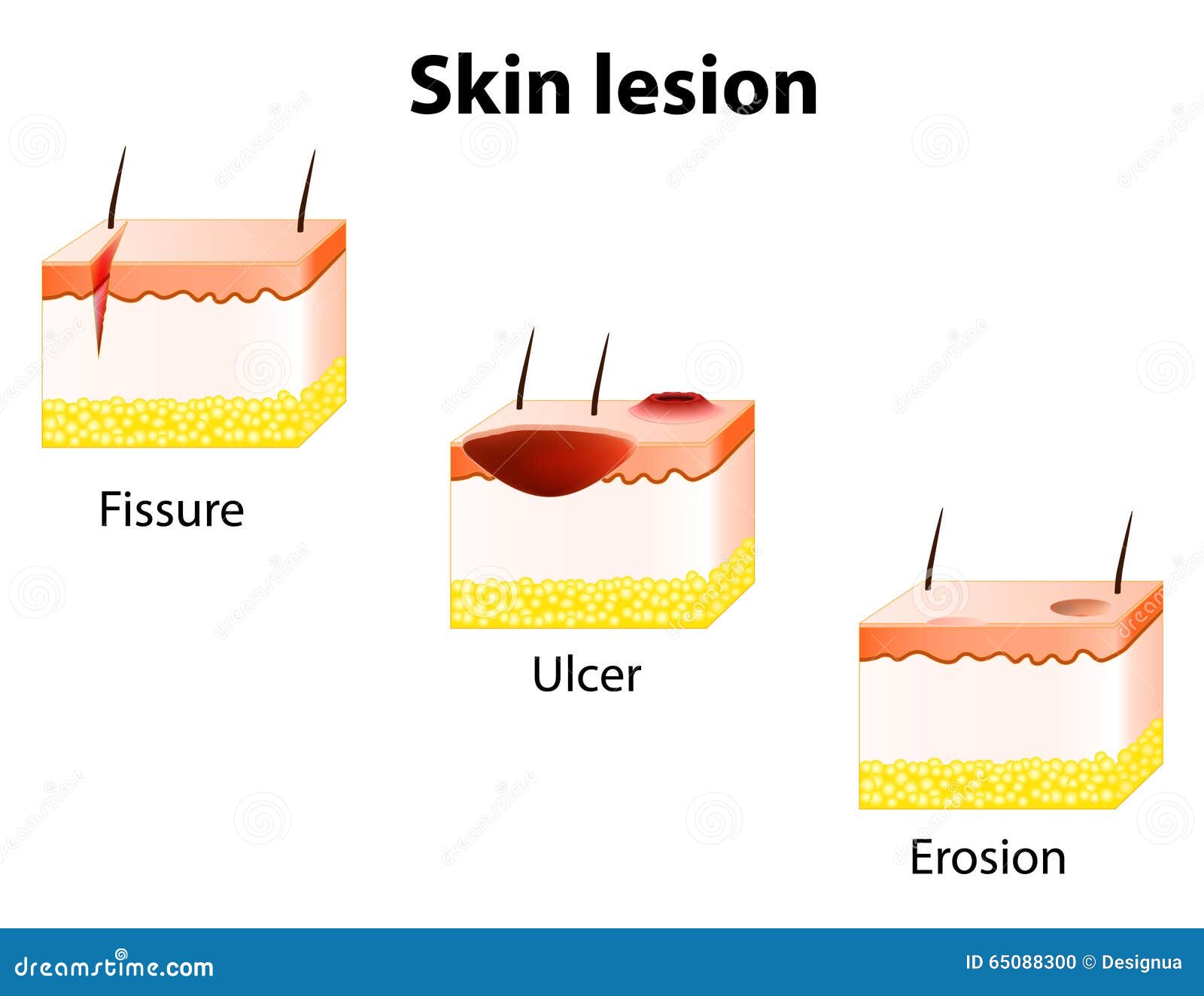 erosion, ulcer and fissure