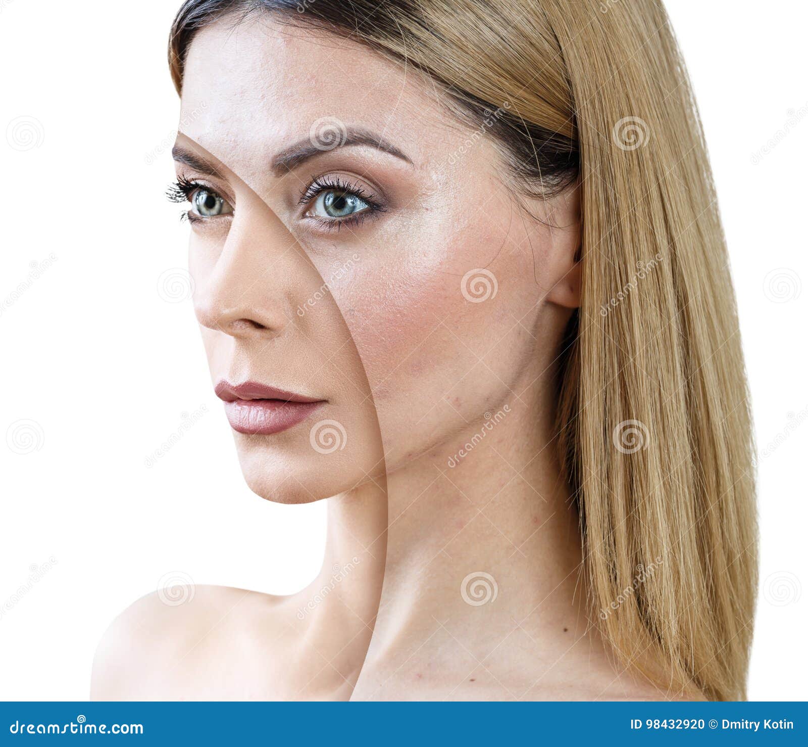 Erwachsene Frau Mit Akne Vor Und Nach Behandlung Stockfoto Bild Von Erwachsene Behandlung