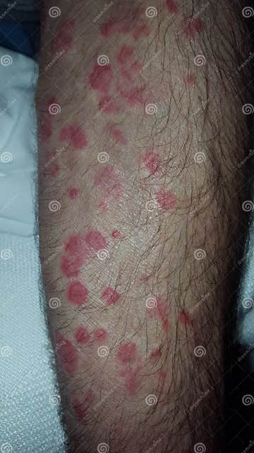 Erythema Multiforme Annular Erythematous Targetoid Skin Lesions Stock ...