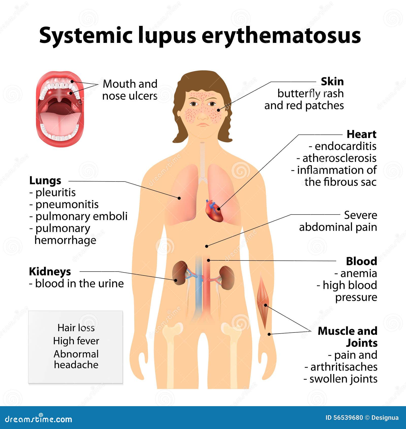 Erythematosu Systémique De Lupus Illustration de Vecteur ...