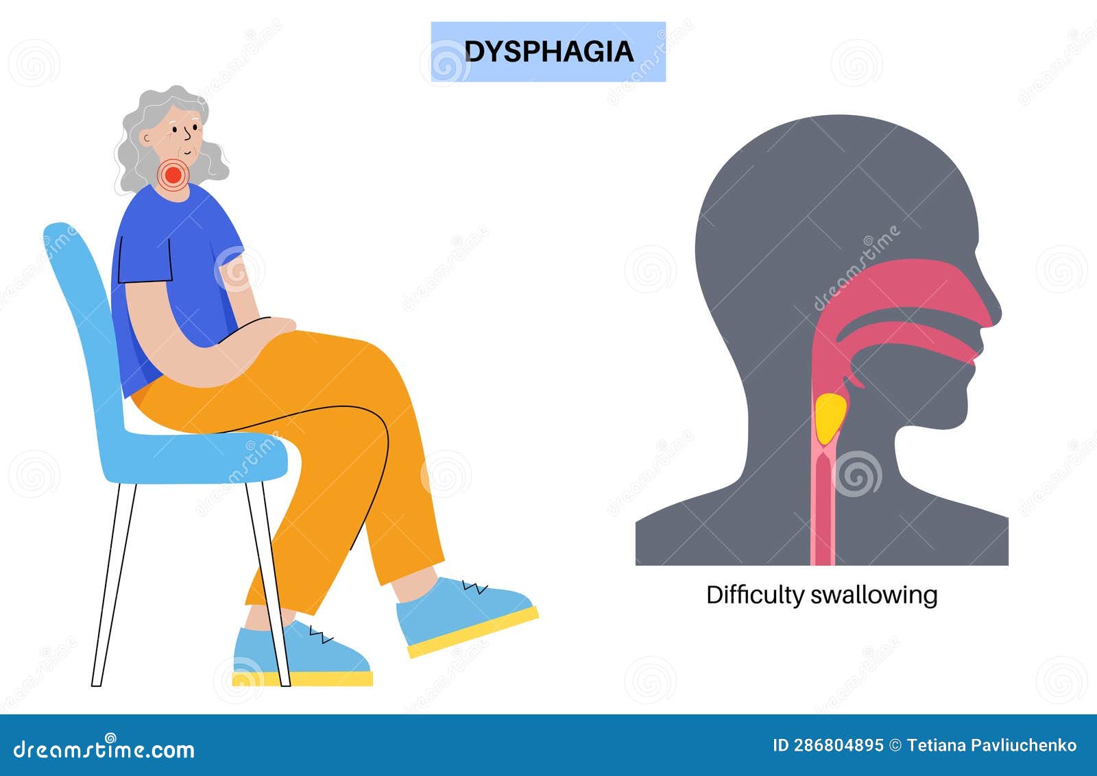 Esophageal Achalasia Disease Cartoon Vector CartoonDealer 287086599 esophageal-achalasia-disease-vector-illustration-cartoondealer