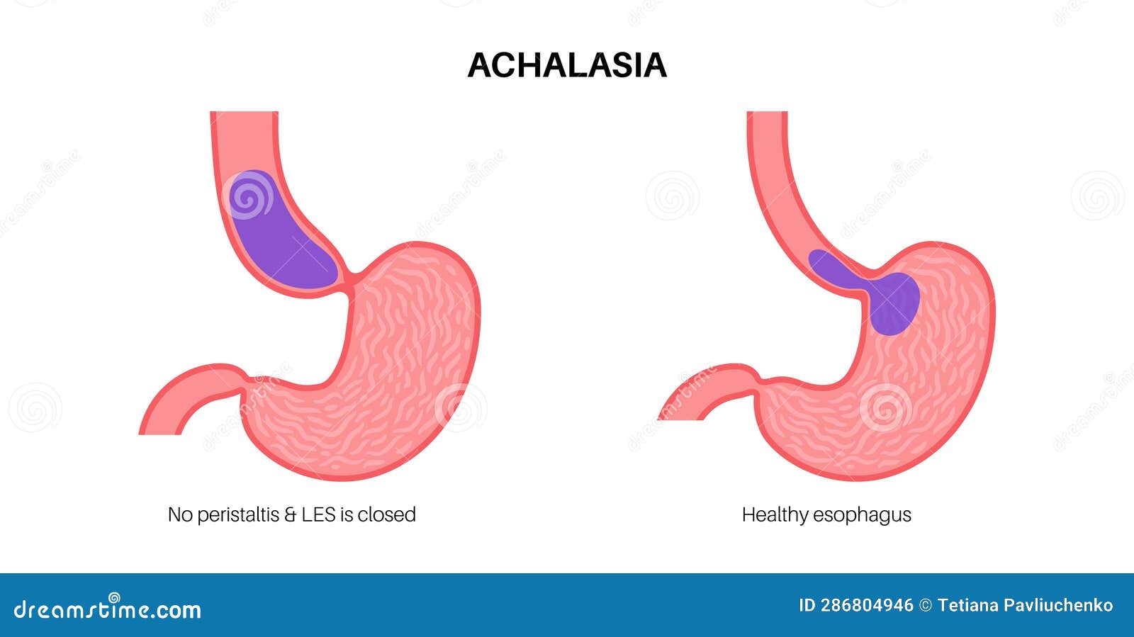 Esophageal Achalasia Disease Cartoon Vector CartoonDealer 287086683 esophageal-achalasia-disease-cartoon-vector-cartoondealer-287086683