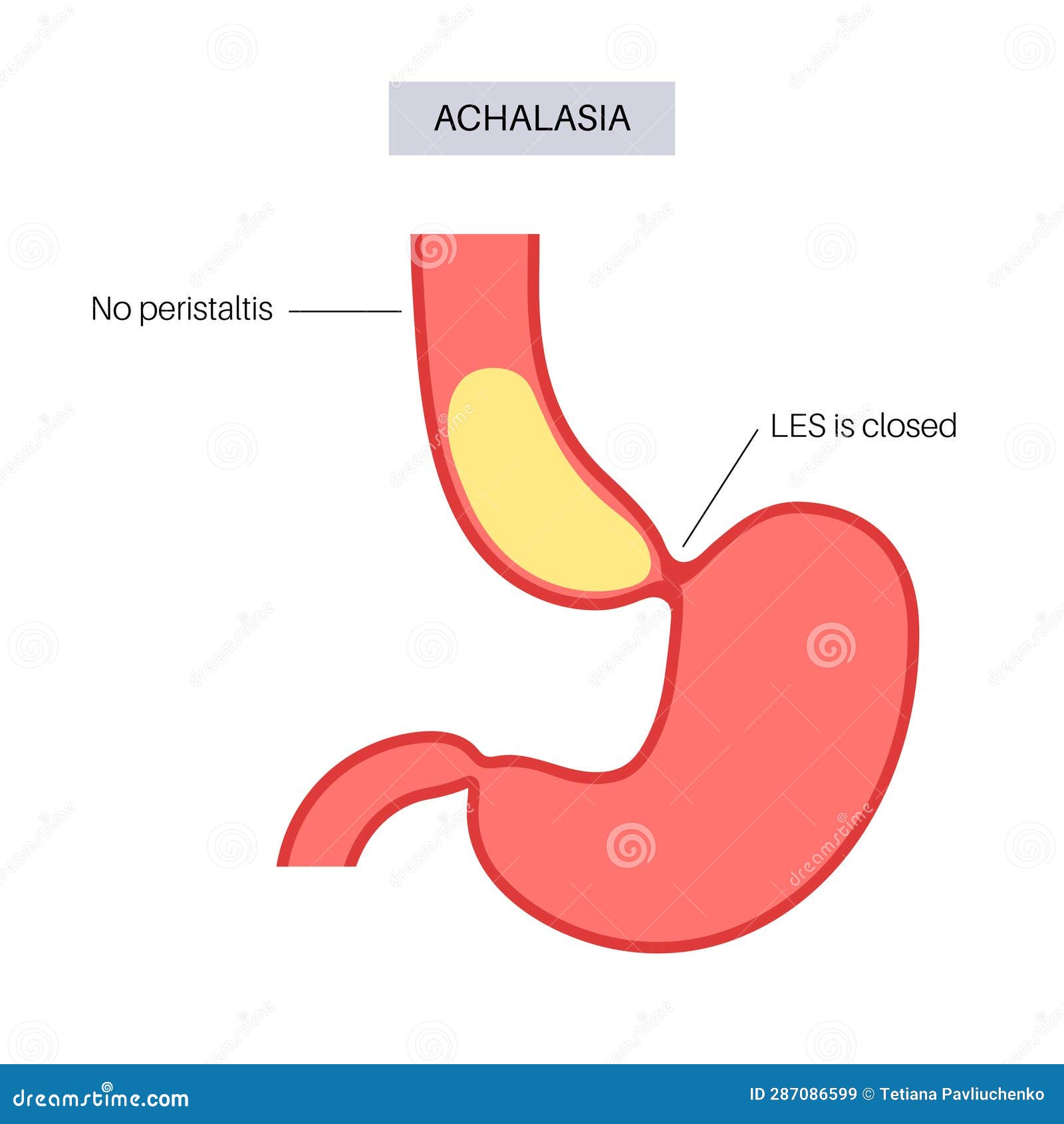 Esophageal Achalasia Disease Vector Illustration CartoonDealer esophageal-achalasia-disease-vector-illustration-cartoondealer
