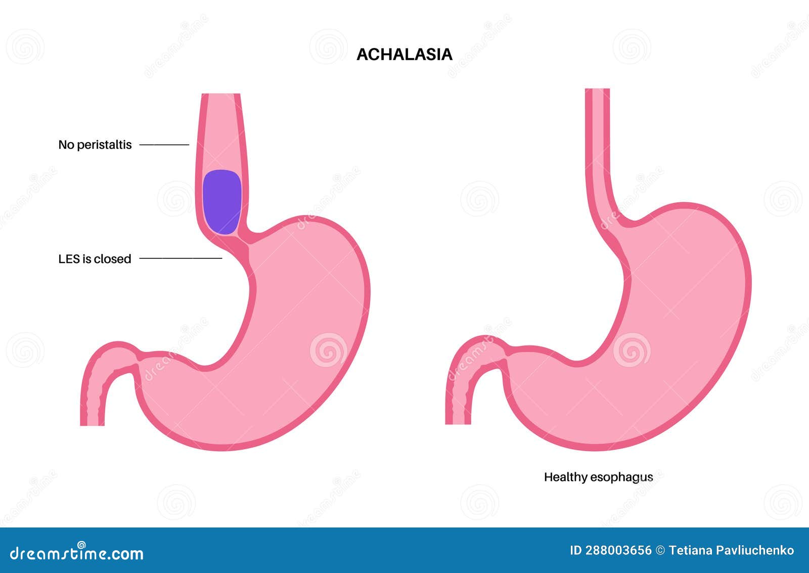 esophageal achalasia disease