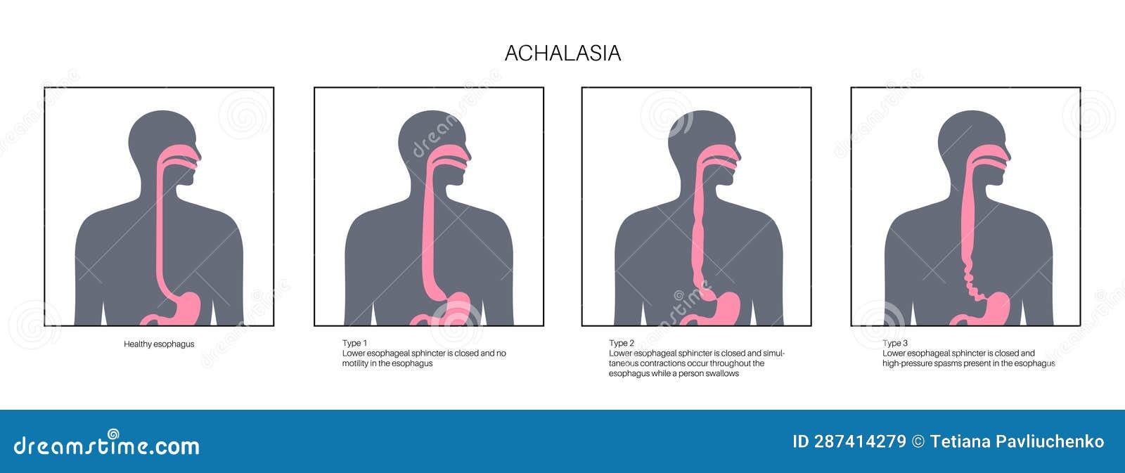 esophageal achalasia disease