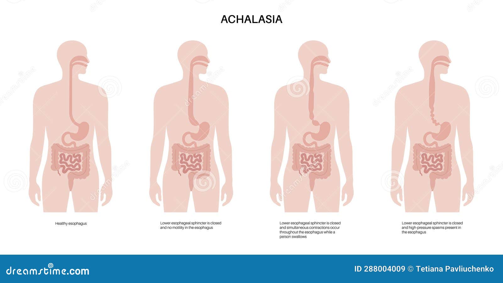 esophageal achalasia disease