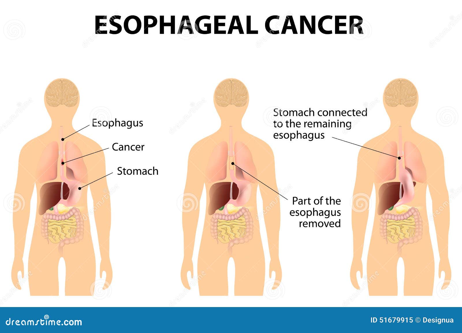 esophageal cancer 