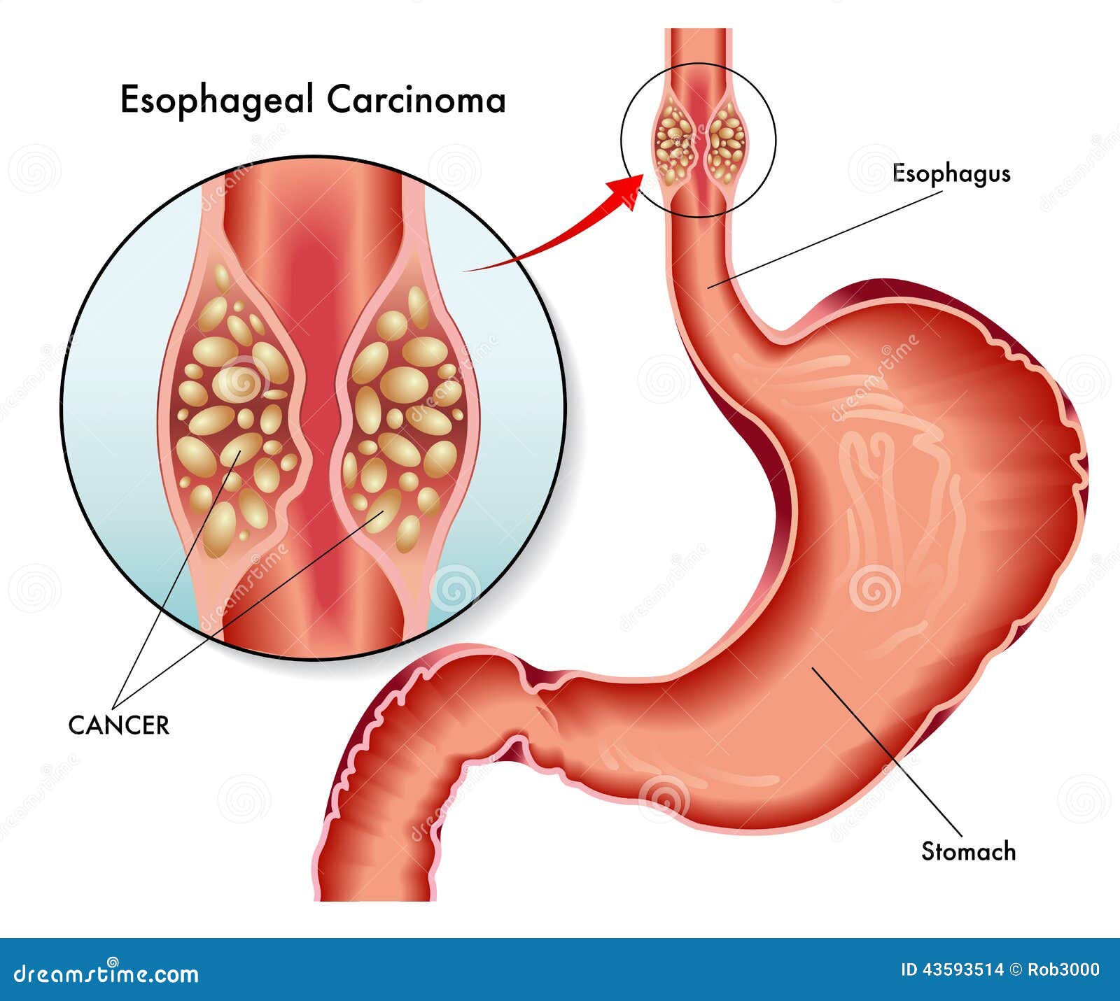 esophageal carcinoma