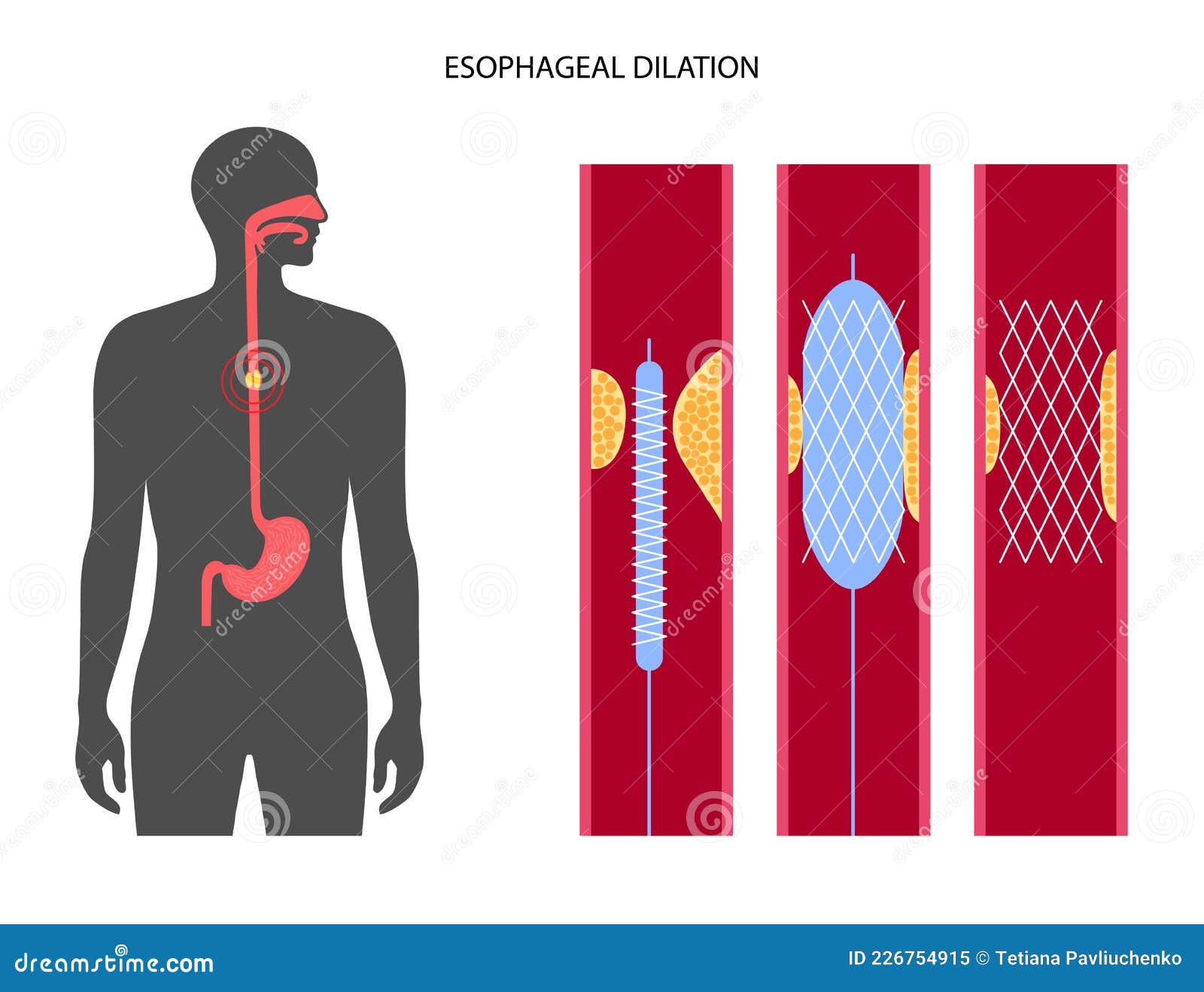 Esophageal Achalasia Disease Cartoon Vector CartoonDealer 286804921 dysphagia-medizzy