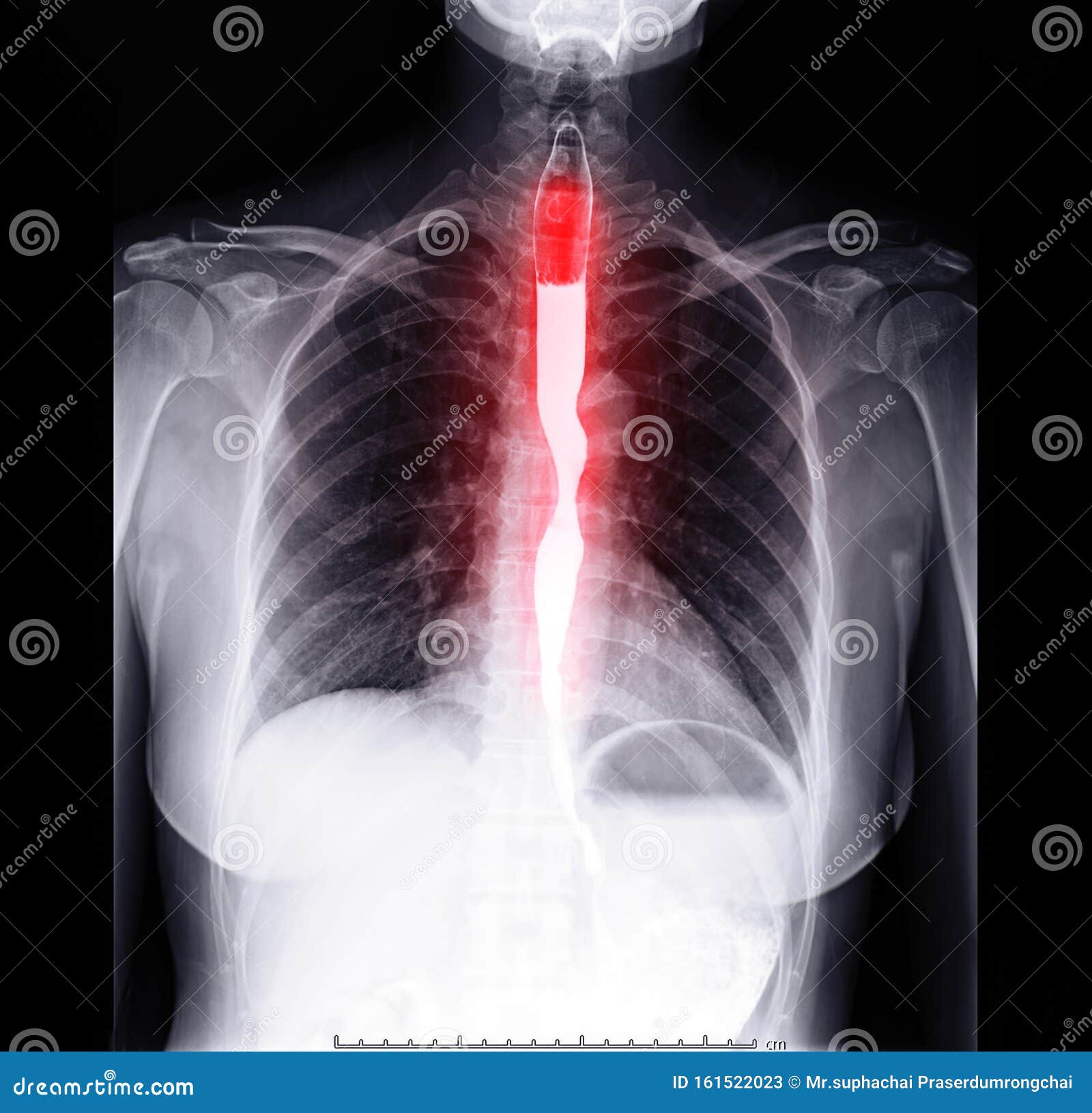 Esophagram or Barium Swallow Front View Showing Esophagus for Diagnosis GERD. Stock Image - Image of gastric, abdominal: 161522023 Esophagram Or Barium Swallow Front View Showing Esophagus For Diagnosis Gerd. Stock Image - Image Of Gastric, Abdominal: 161522023