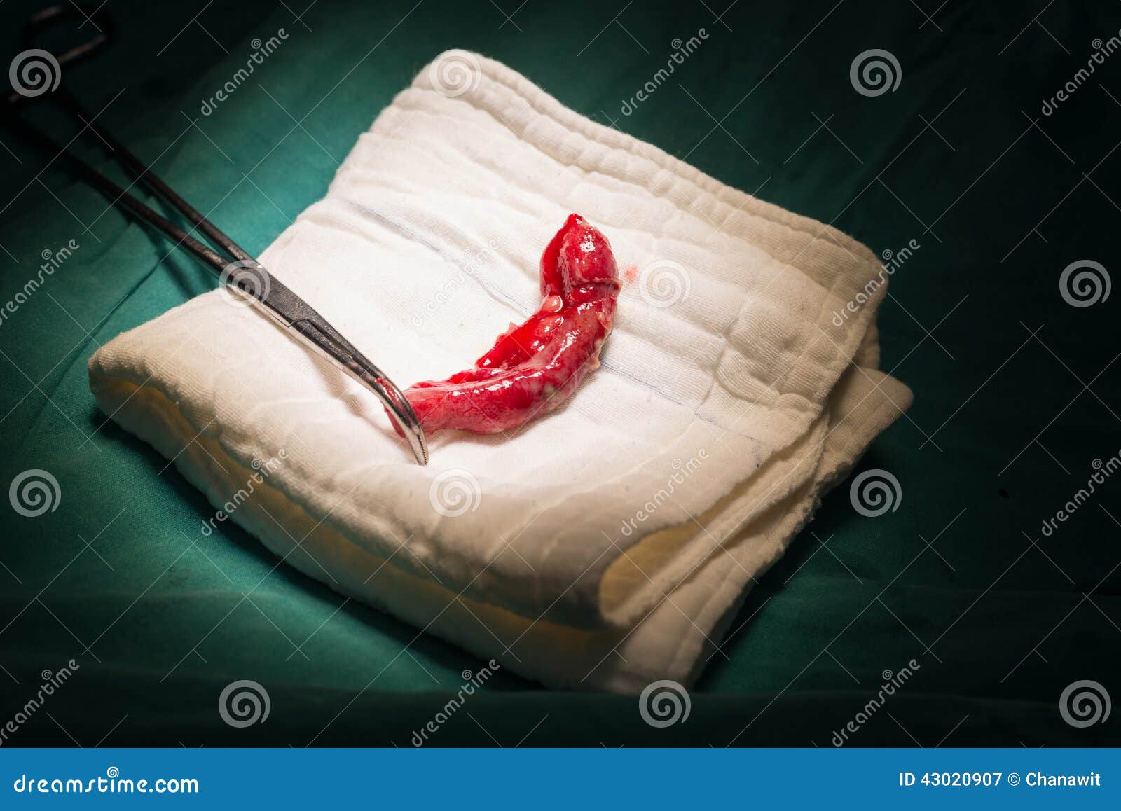 Espécime De Apêndice De Apendicectomia Imagem de Stock - Imagem de humano,  corpo: 43020907, image size:1600x1158