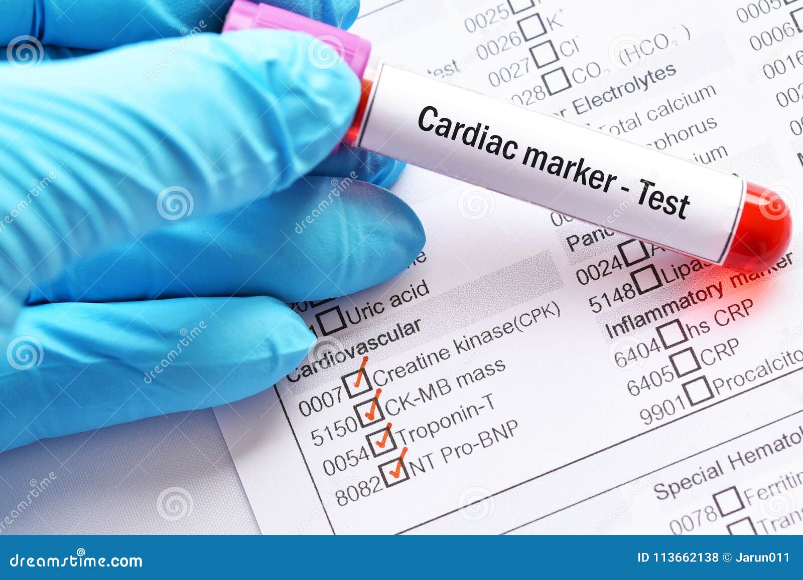 Essai Cardiaque De Marqueur Photo stock Image du enzyme, infarctus 113662138