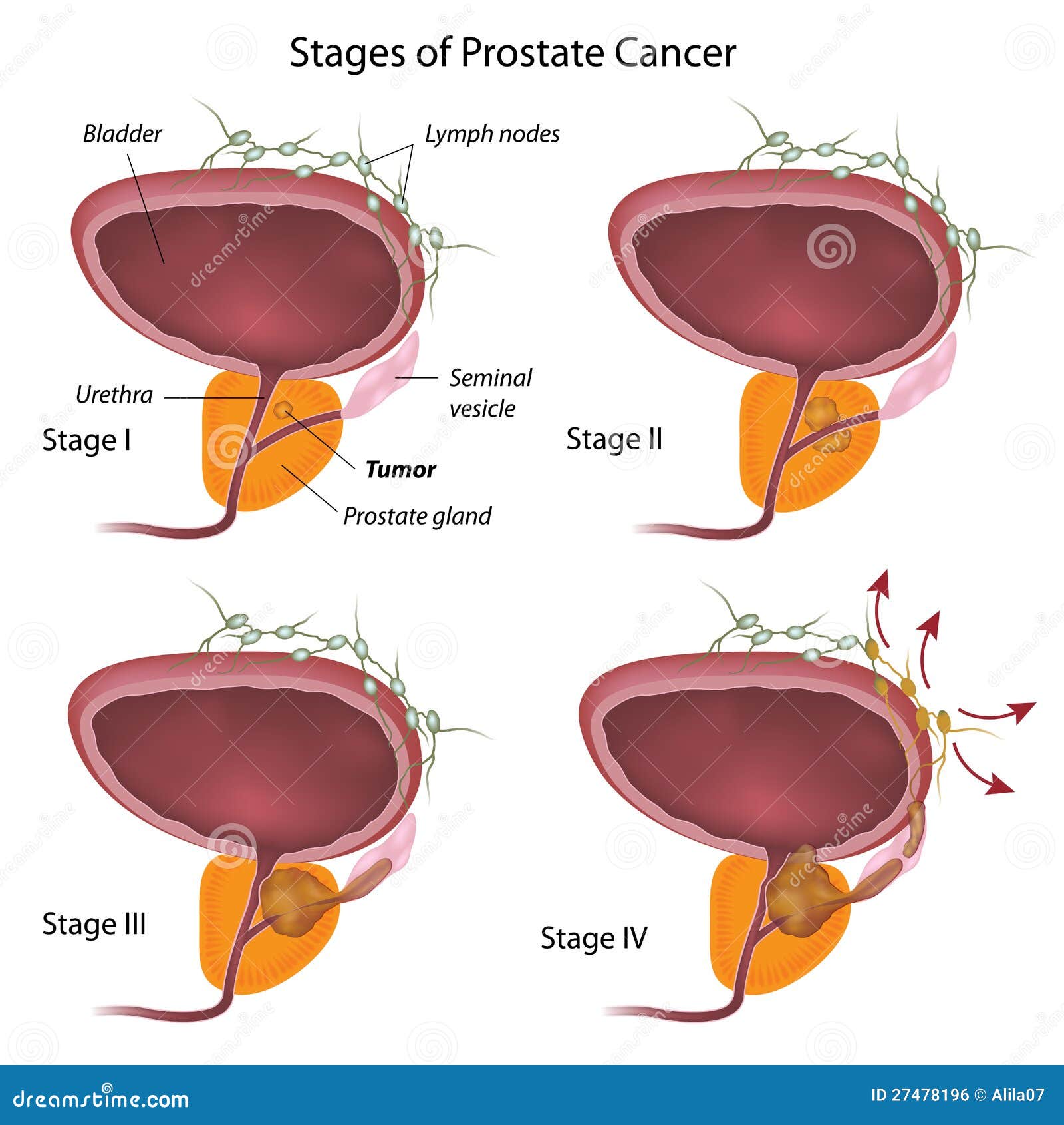 etapas del cáncer de próstata)