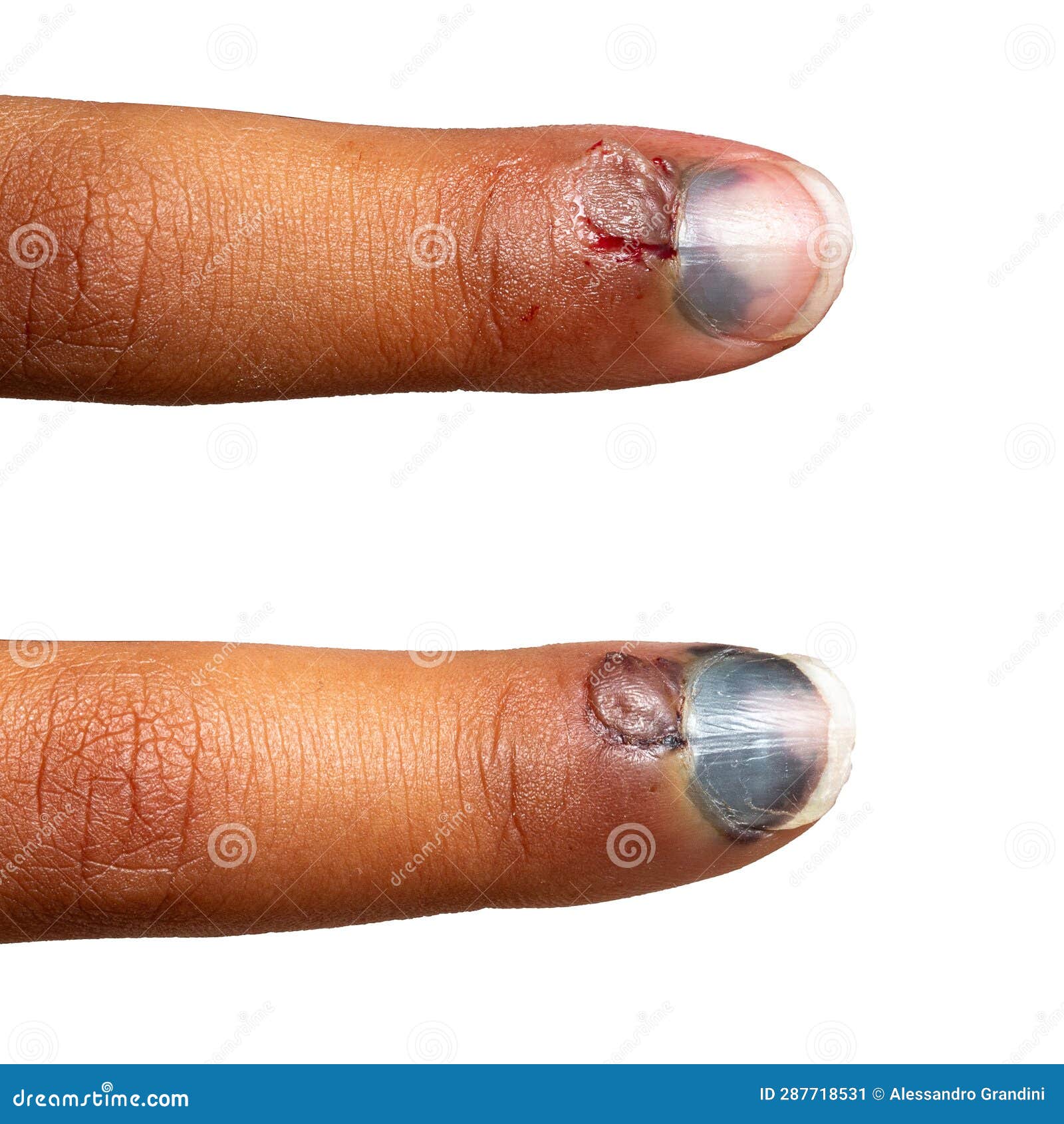 Evolution of the Hematoma of a Crushed Finger Stock Image Image of