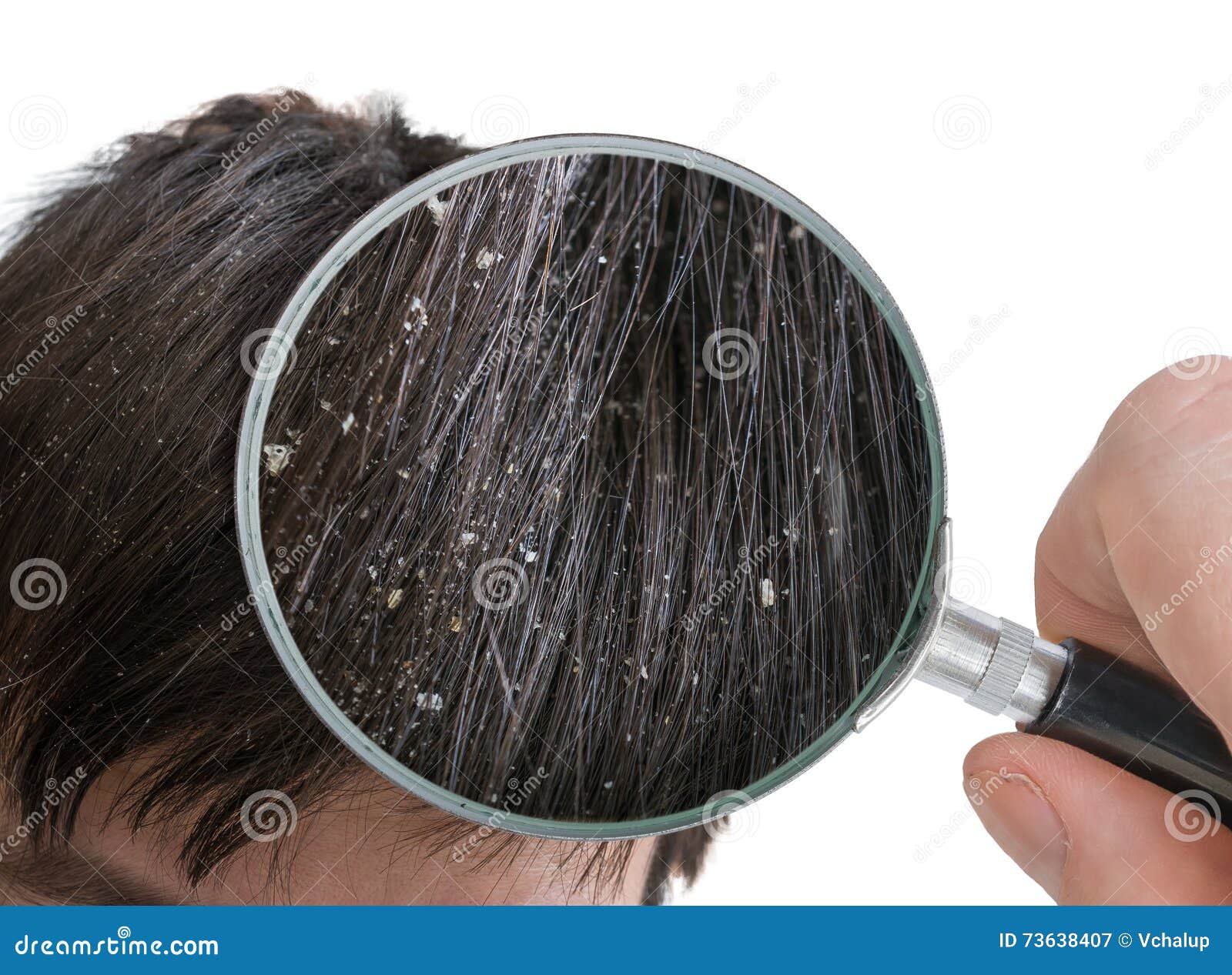 Examiming White Dandruff Flakes In Hair With Magnifying Glass