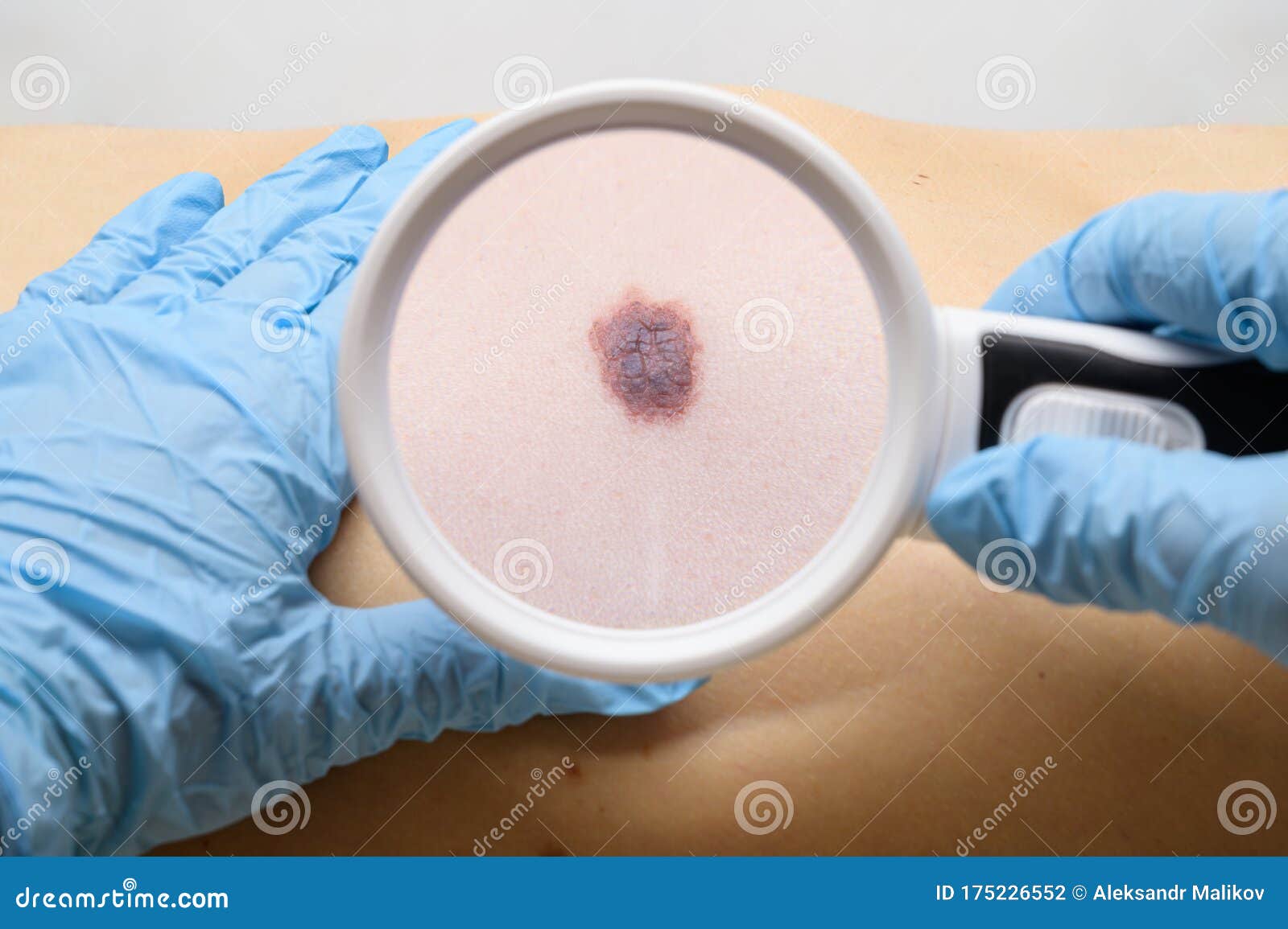 examination of a mole on the patient`s body. the concept of studying moles to prevent the development of skin cancer or melanoma