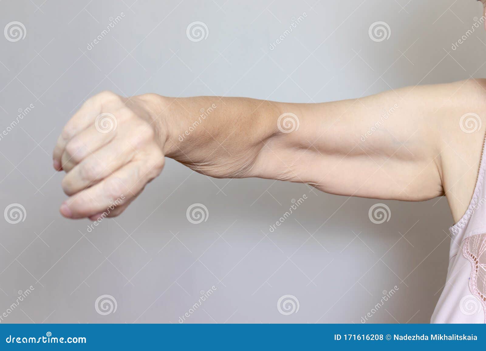 an excess loose skin on an arm of a senior elderly woman after extreme weight loss