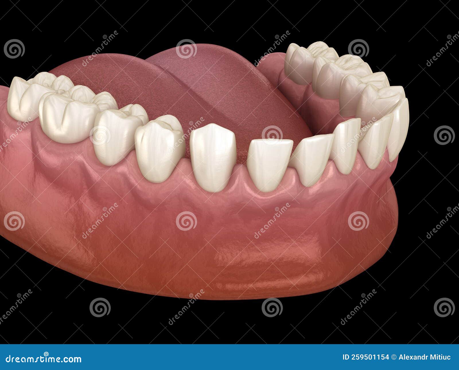 Excessive Spacing between Teeth. Dental 3D Illustration Concept Stock