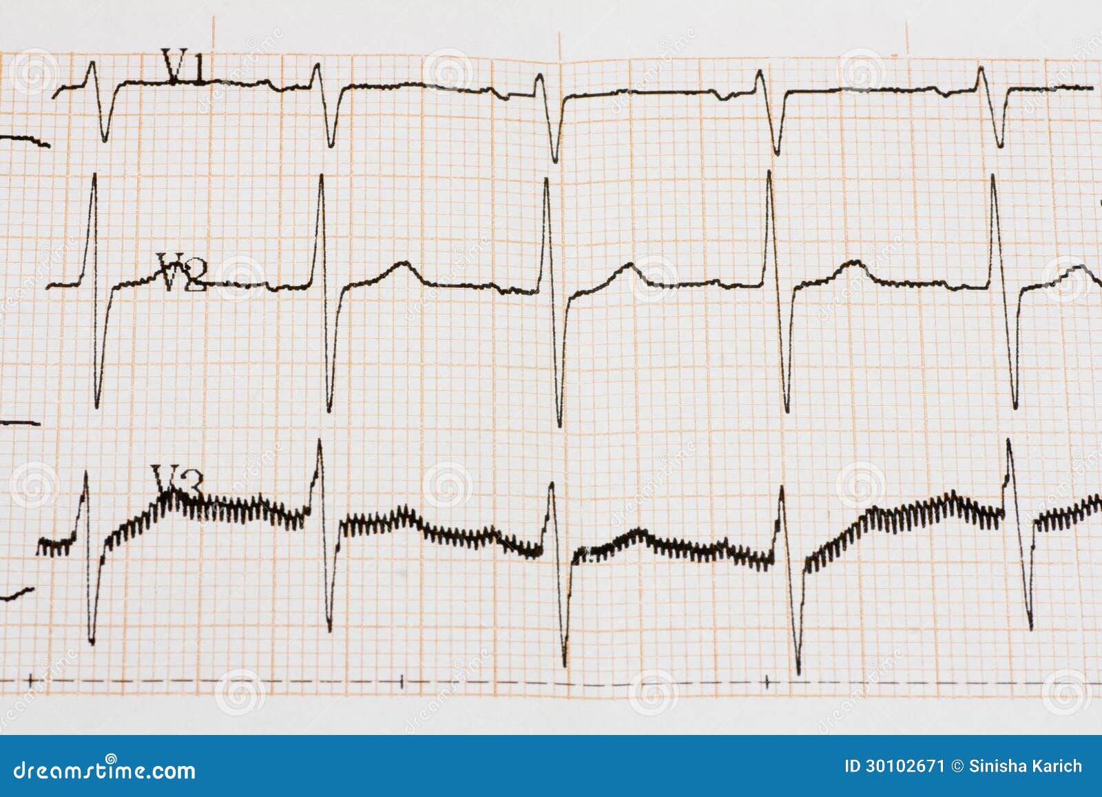 Arrhythmia Chart