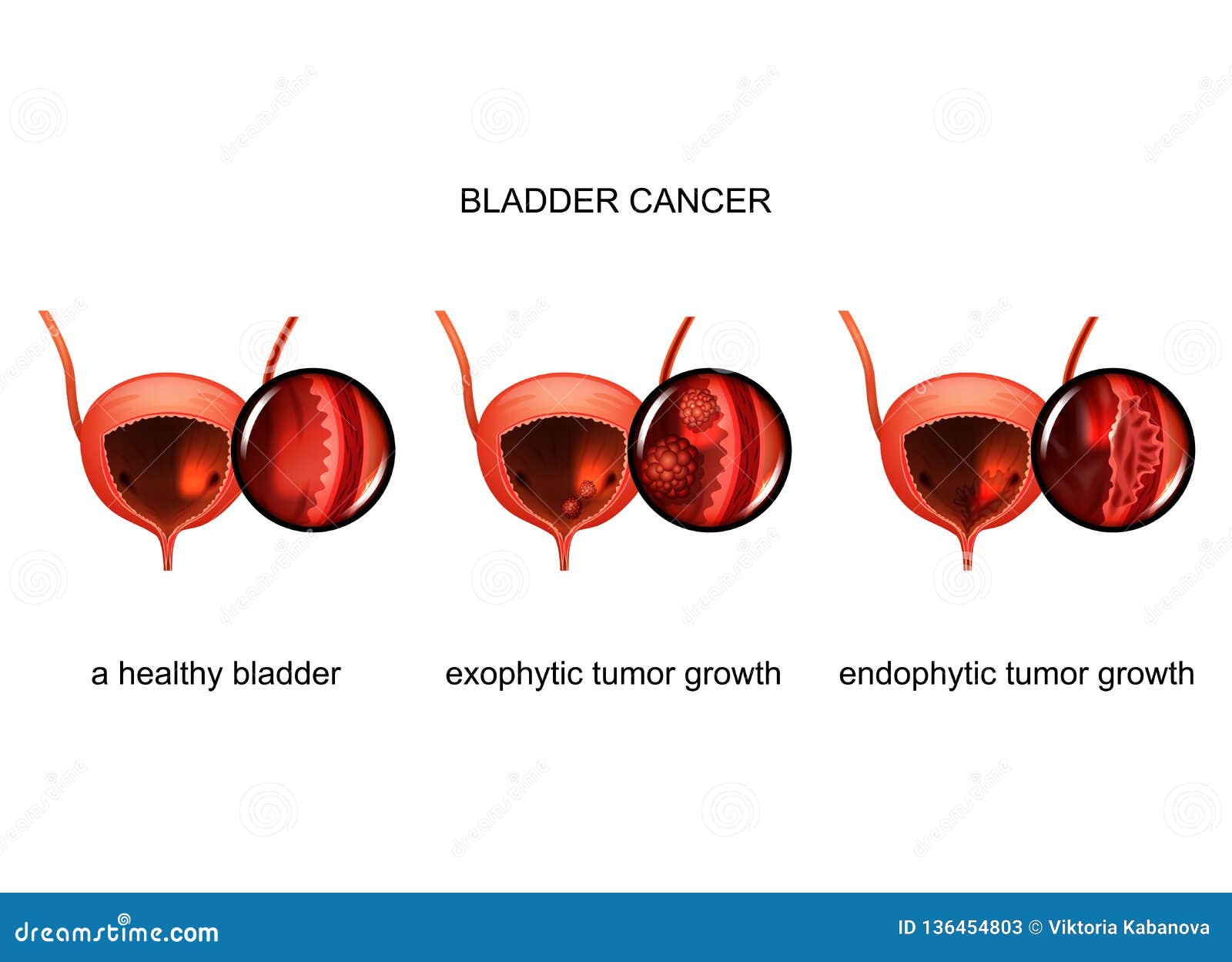 Exophytic and Endophytic Growth of Cancer in the Bladder Stock Vector