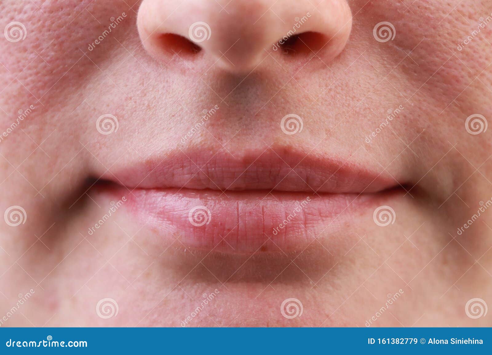 Expanded Pores Acne Comedones Black Spots Lips Close Up