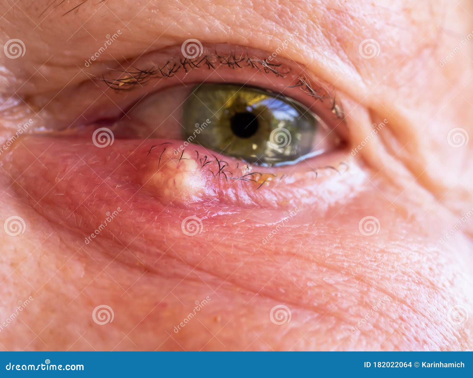 An External Stye on the Lower Eyelid Stock Photo Image of close